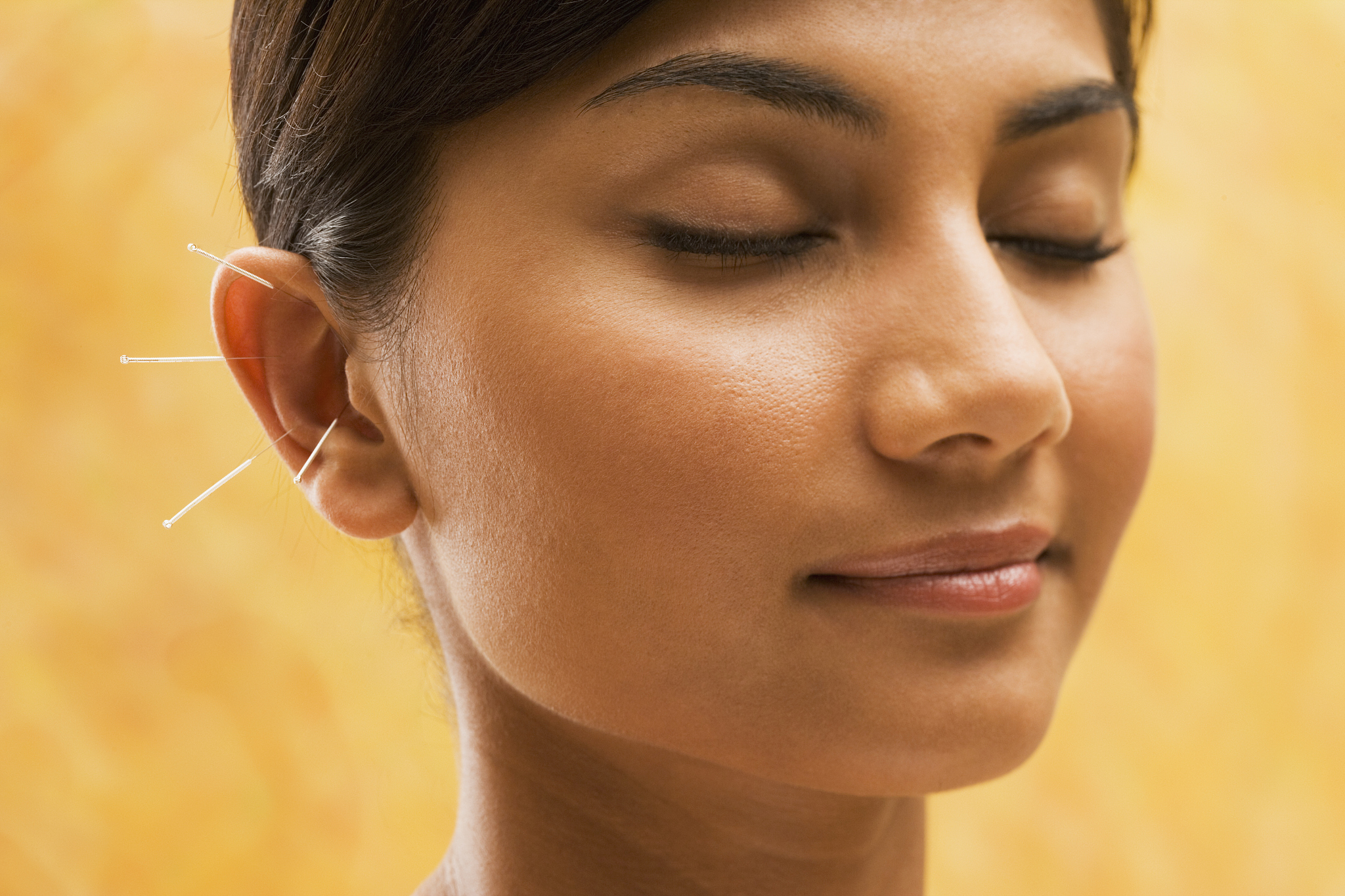 young woman getting acupuncture treatment