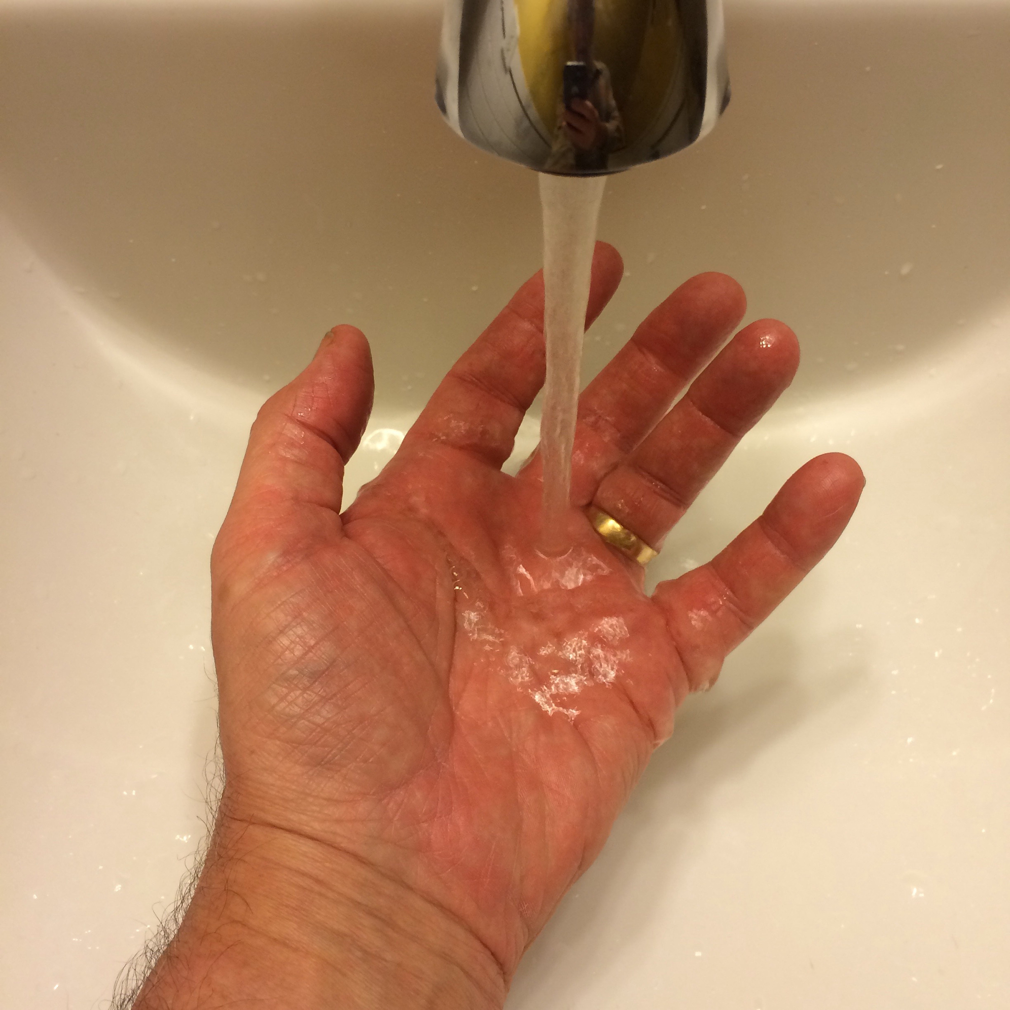 烫伤水泡流浓怎么办？处理方法及就医建议