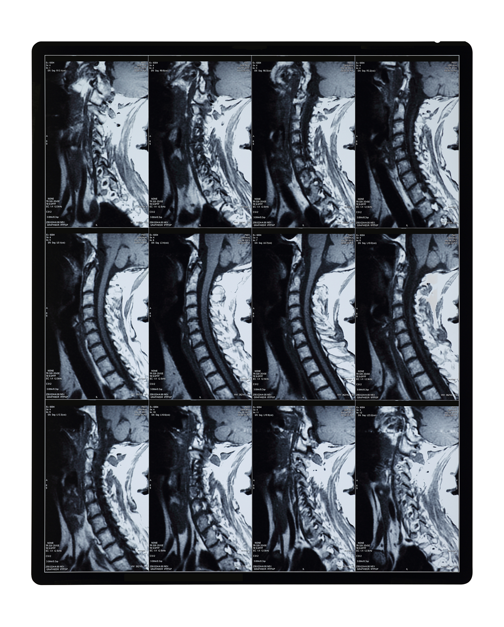 合理的改写下面这段文字：椎间盘的退变引起部分或全部的纤维环破裂进而单独或与髓核、软骨终板一同脱出严重损害窦椎神经和周围神经根