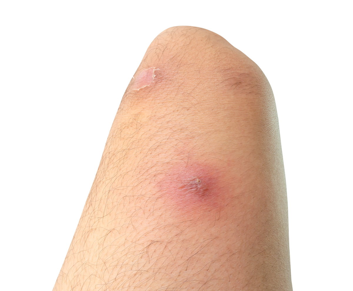 如何判断深部脓肿已经形成