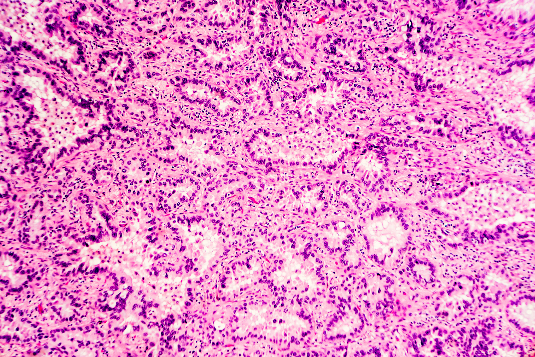 右肺上叶肿瘤诊断：脱落细胞学检验的5大优势