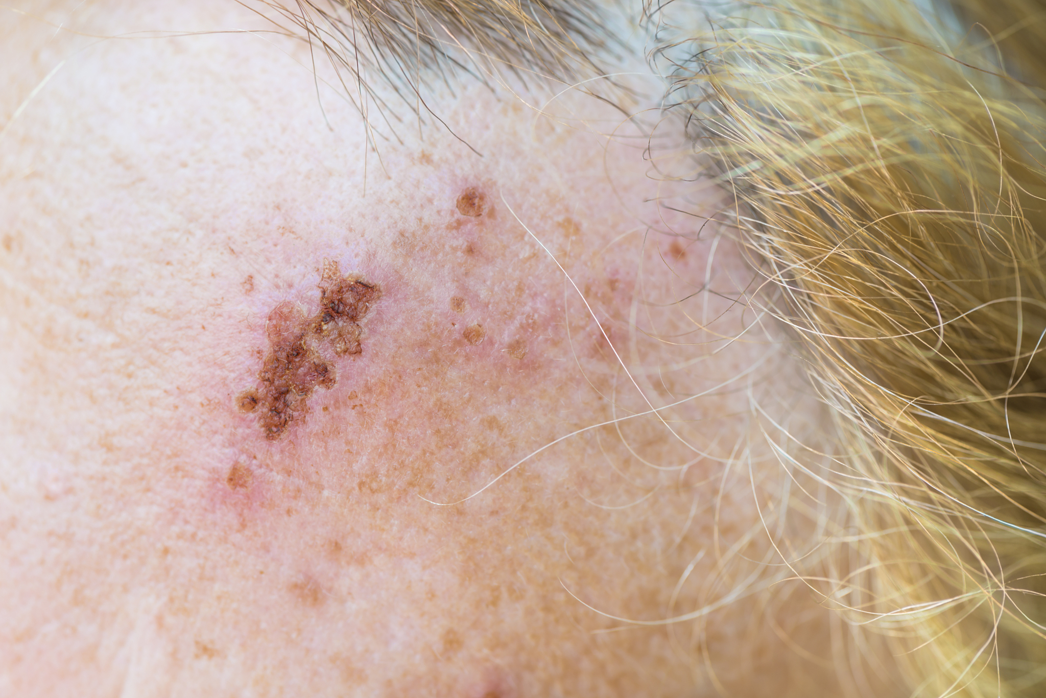 herpes zoster