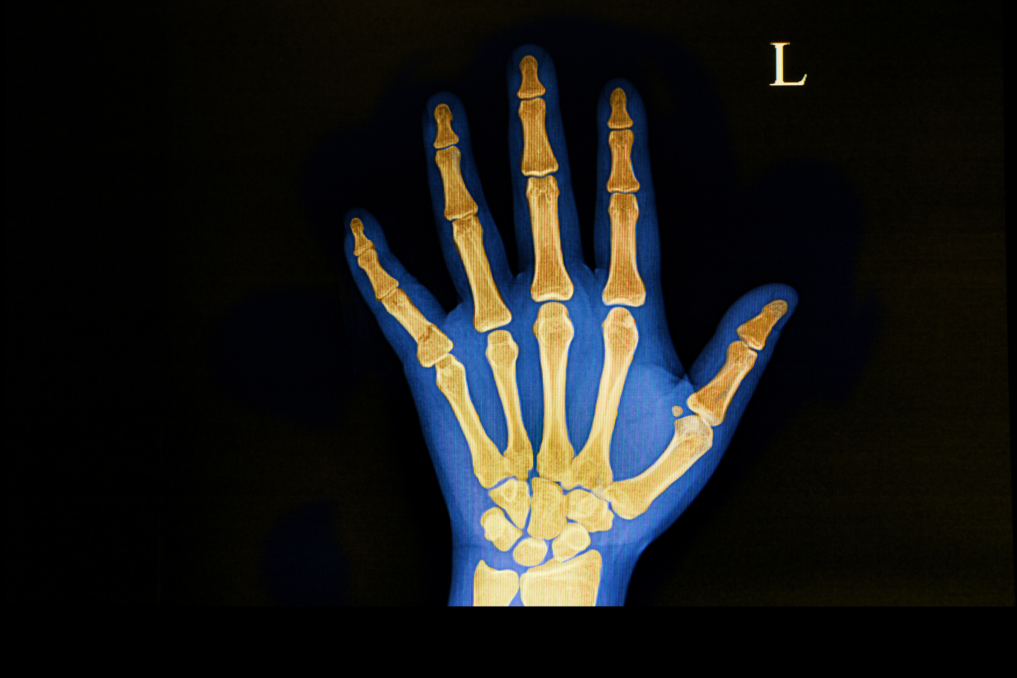 fracture of the base of fifth metacarpal bone