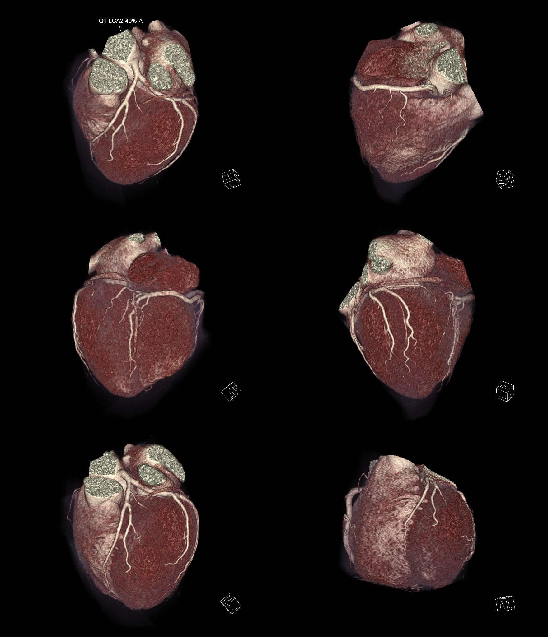 右肺腺癌术后呼吸衰竭伴右下肢肌肉脓肿引流术后患者护理