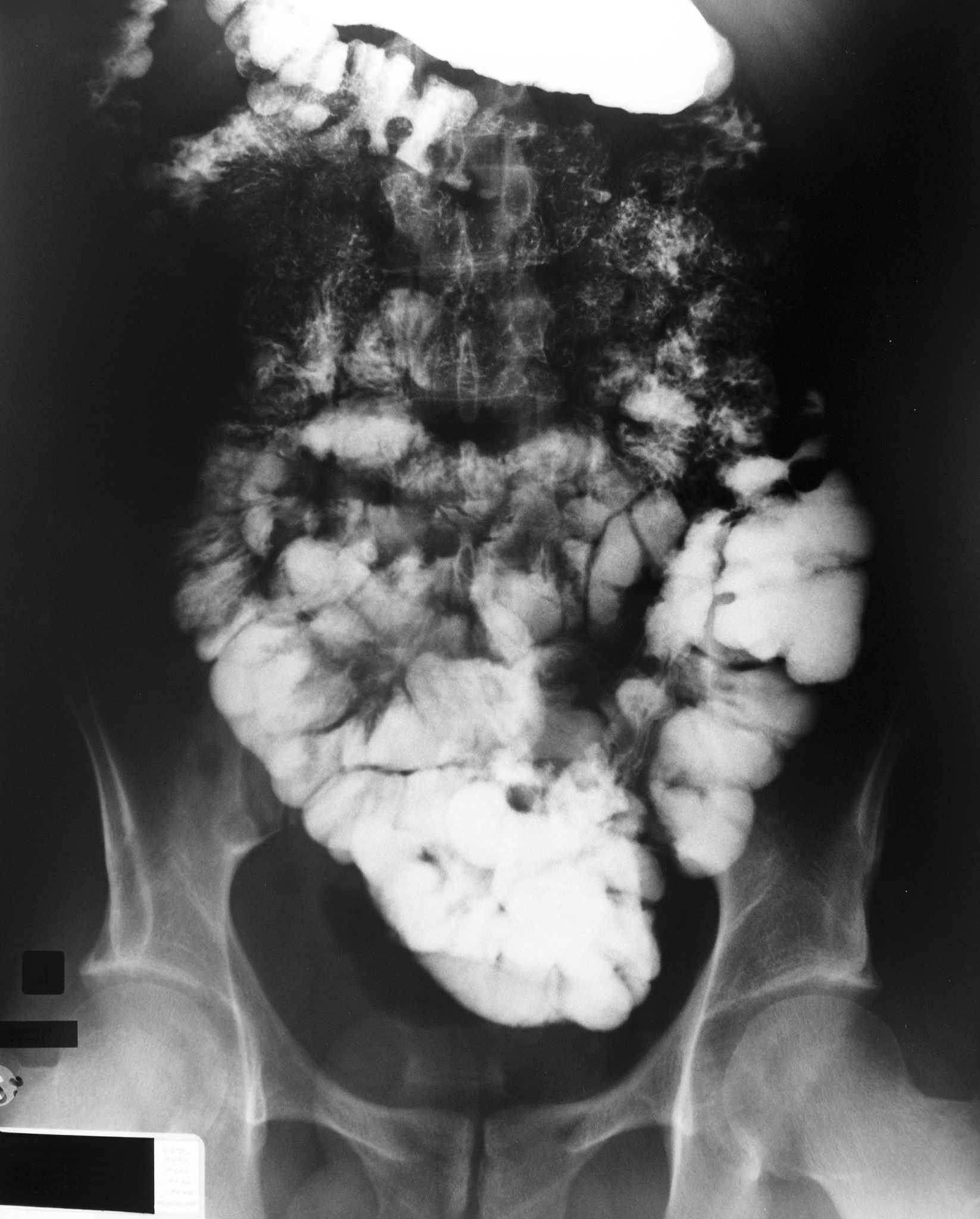 十二指肠溃疡：严重吗？你需要知道这些