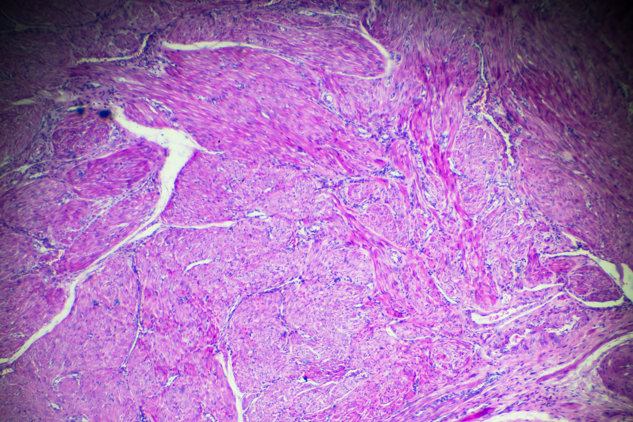 早期子宫内膜癌的需要腹主动脉淋巴结活检的包括以下哪几种情况A、乳头状浆液性腺癌B、子宫内膜样腺癌G3C、肌层浸润212D、灶累及宫腔面积超过50或有峡部累及