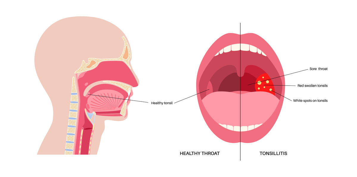 咽峡的位置和功能：了解你的喉咙