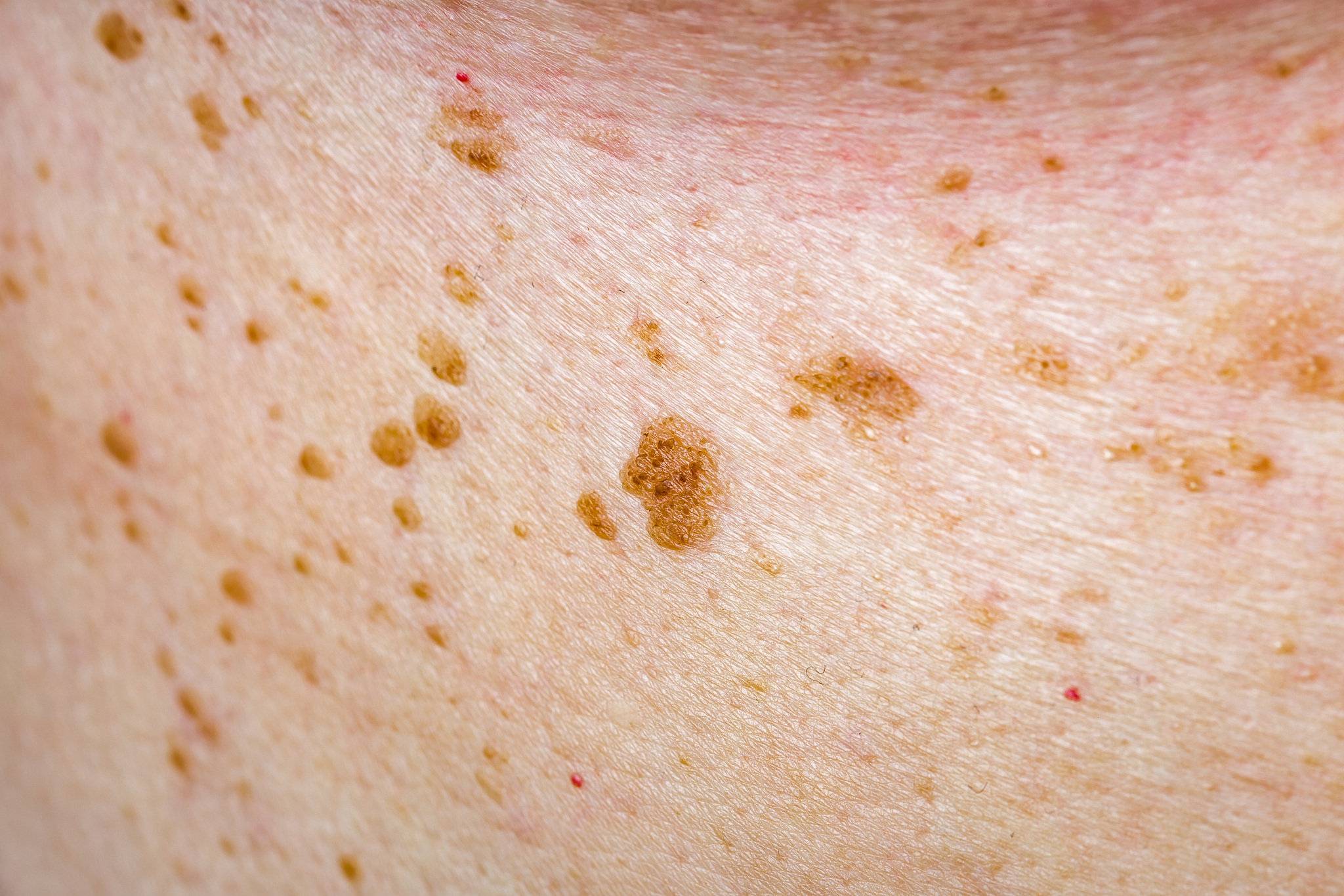 many nevus on human skin