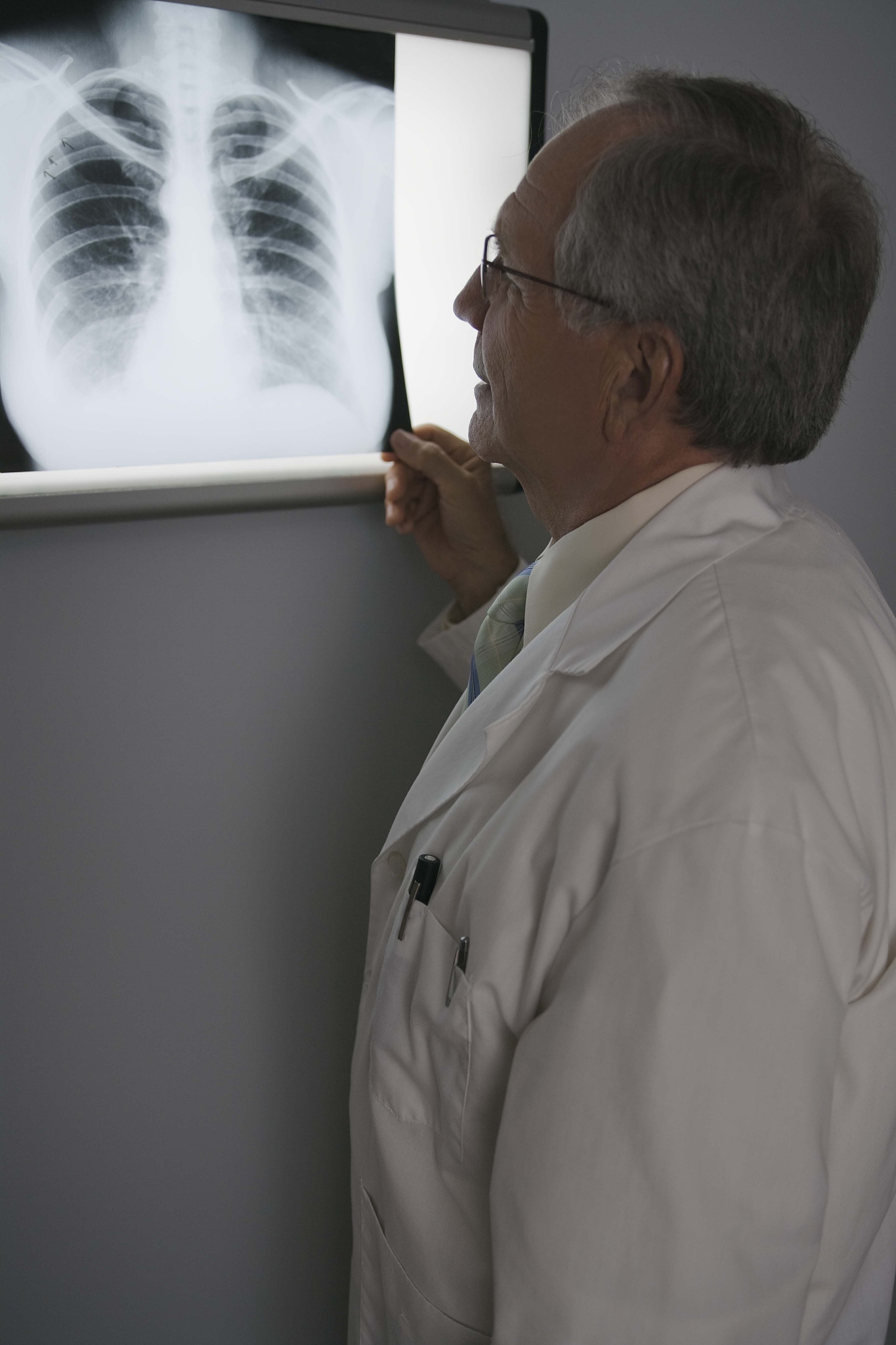 老年男性胸腔积液合并结肠癌肺转移的8个风险