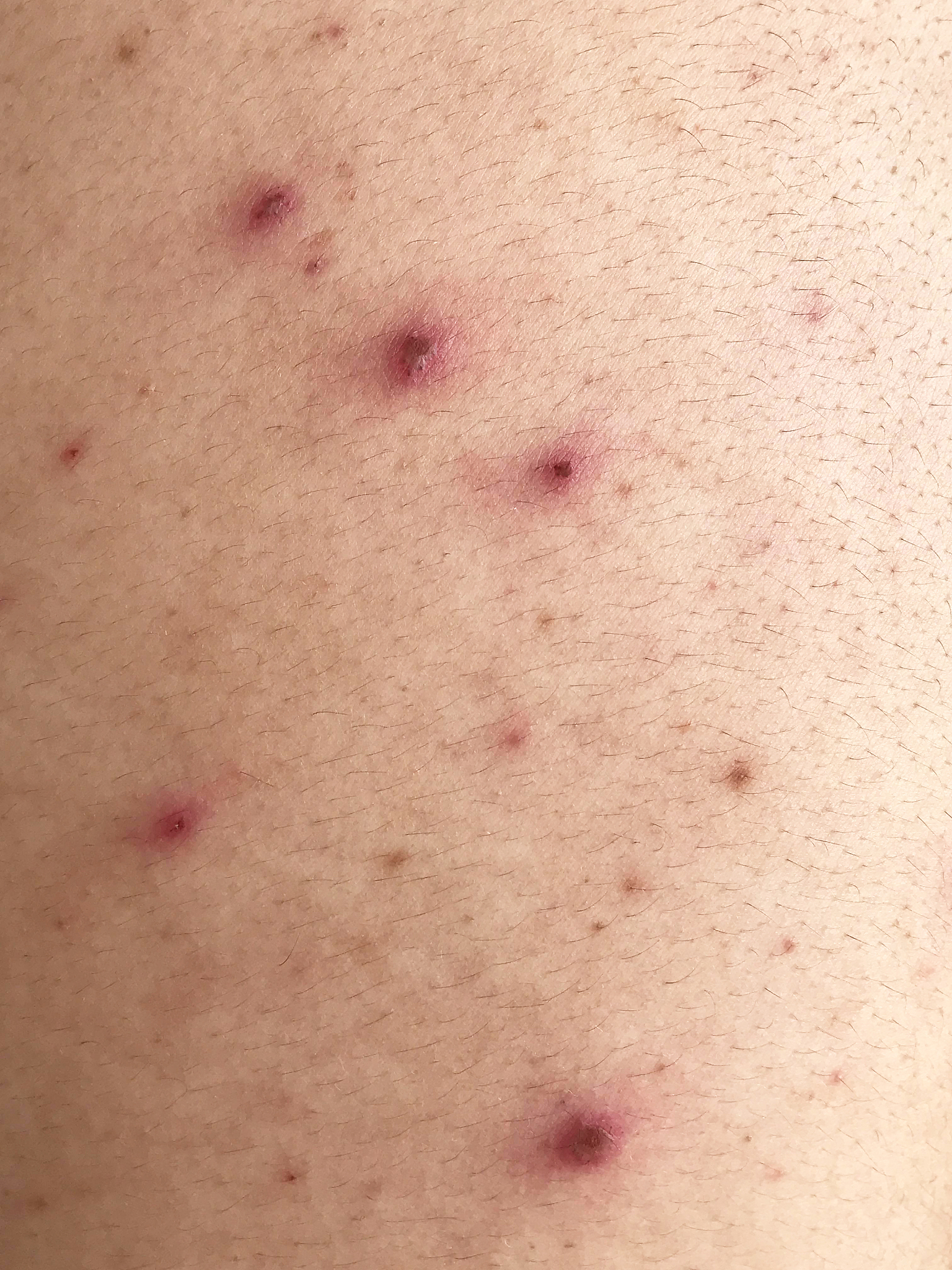 man back having varicella blister or chickenpox