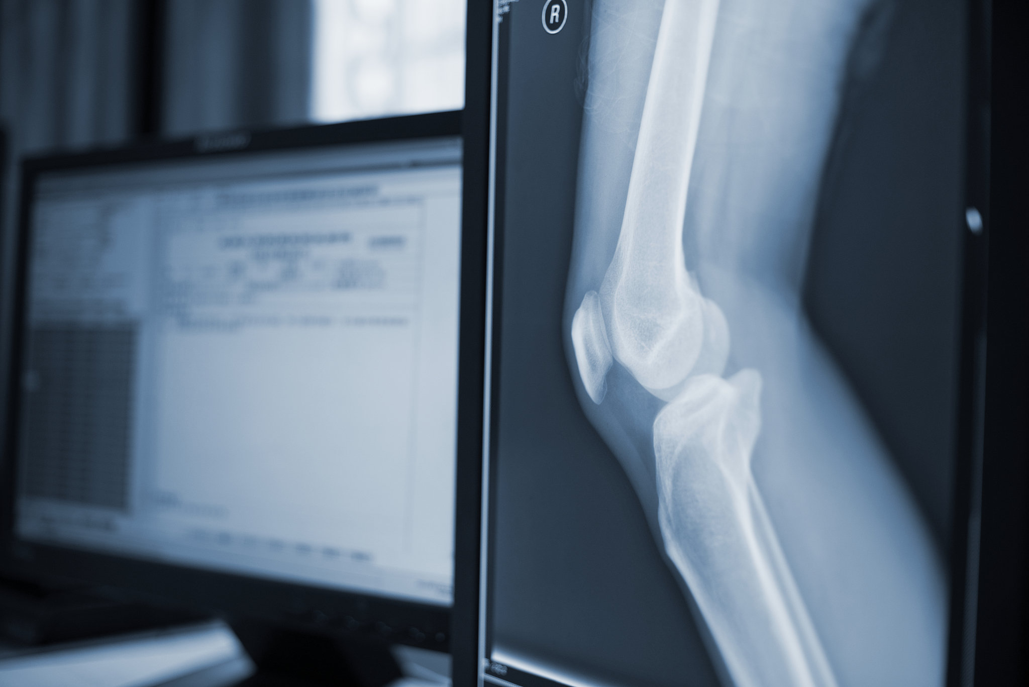 对以下内容进行润色：试验组在CT扫描的基础上结合三维重建图像将患者的骨折分为：三种类型CT平扫可见股骨皮质断端连线呈阶梯状或者骨折断端之间出现股骨颈轴向转动移位双侧股骨颈皮质出现断裂；2型CT平扫示骨折断端侧或两侧股骨皮质连线平滑病人双侧股骨颈皮质有断裂生成骨折断端之间无股骨颈轴向转动移位；1型CT平扫表现为病人一侧股骨颈皮质生成断裂和股骨皮质的不连续。观察组CT-三维再3型骨折人工关节置换术；2