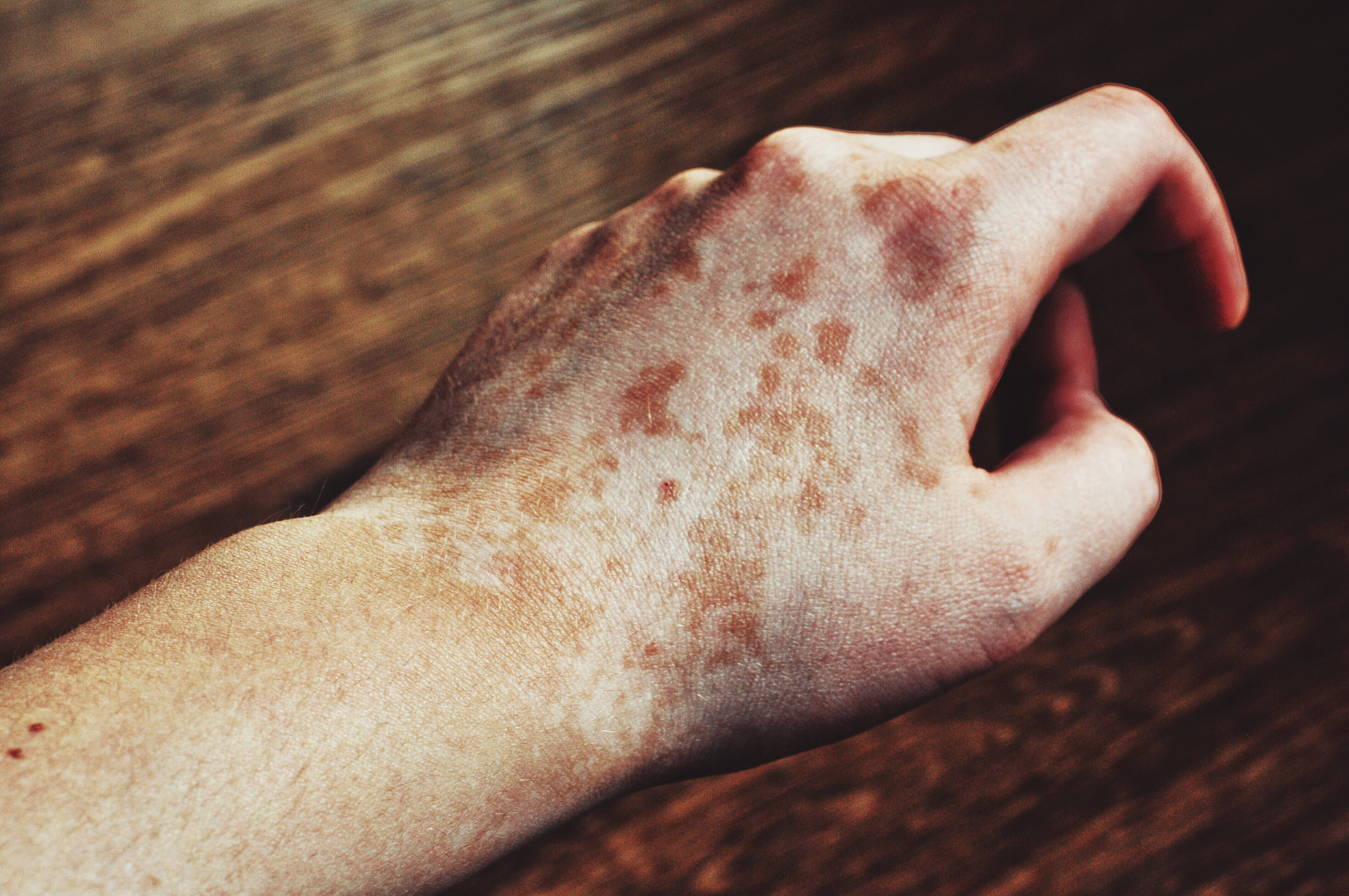 快速治疗汗疱疹的方法：有效缓解皮肤炎症