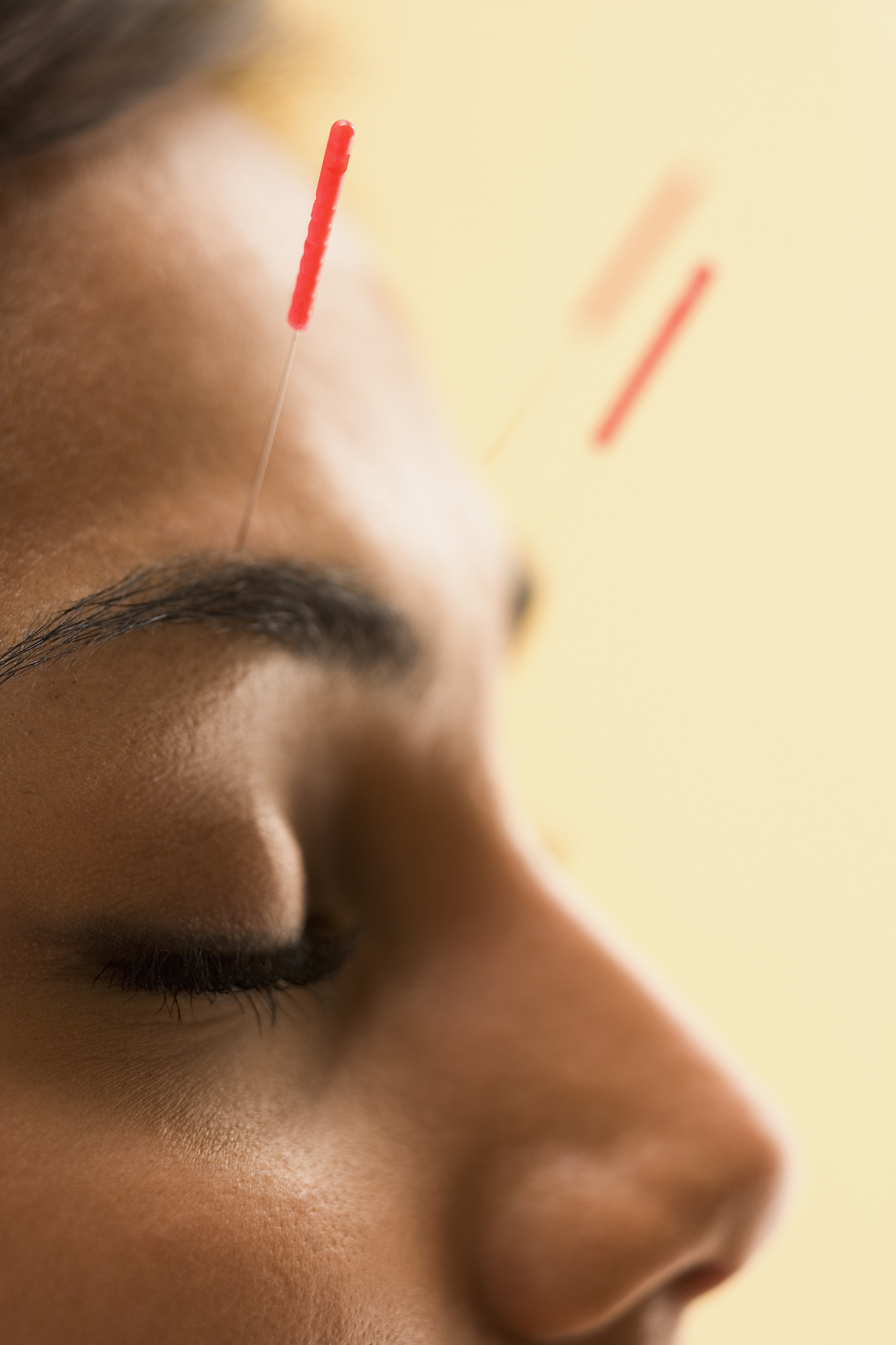 young woman getting acupuncture treatment