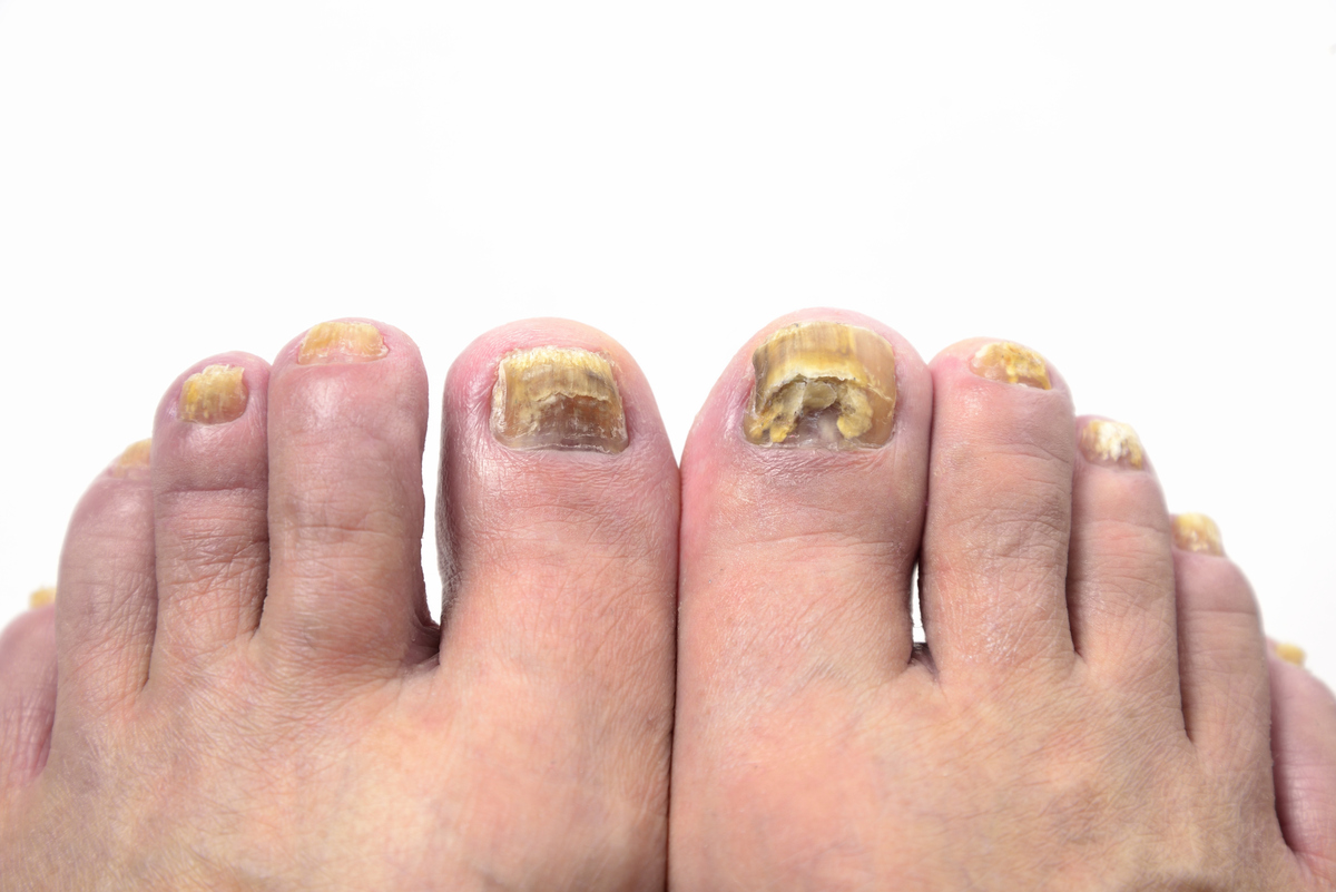 脚指甲长肉里怎么办？有效缓解疼痛和感染的方法