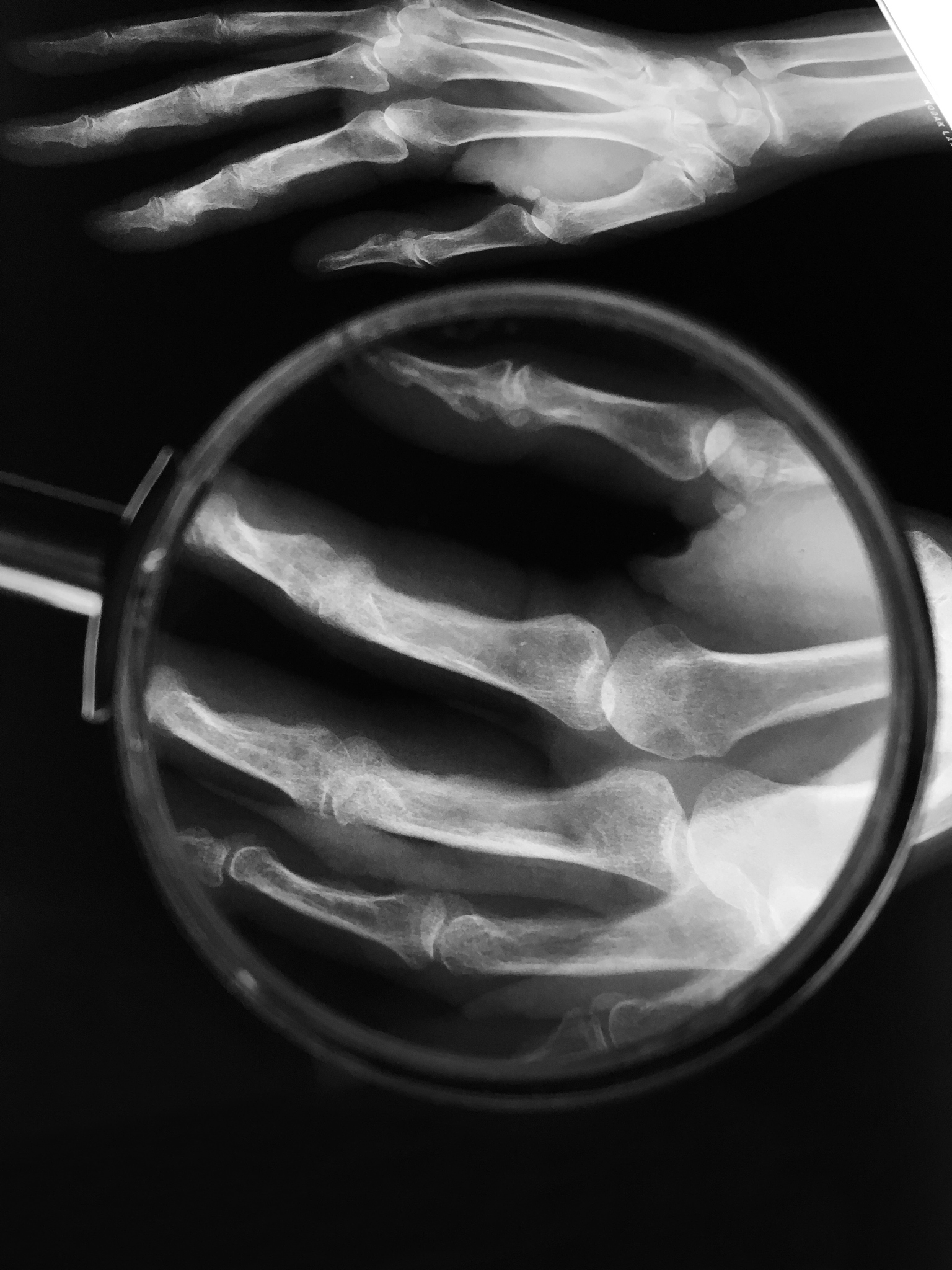 对以下内容进行润色：提示螺旋CT扫描和三维重建技术能明显改善股骨颈骨折病人预后这也侧面证明螺旋CT扫描和三维重建技术在股骨颈骨折病人骨折分型和损伤评估中的准确性和可靠性显着高于X线片。螺旋CT采用轴位断层扫描扫描速度快不受病人体位或解剖结构的影响。综合检查病人处理速度较快单次扫描可完成冠状位、矢状位及横断重建图像等对骨折损伤状况能真实地反映出来对隐匿性骨折亦能准确地判断出来避免了有影响交叉的可能性