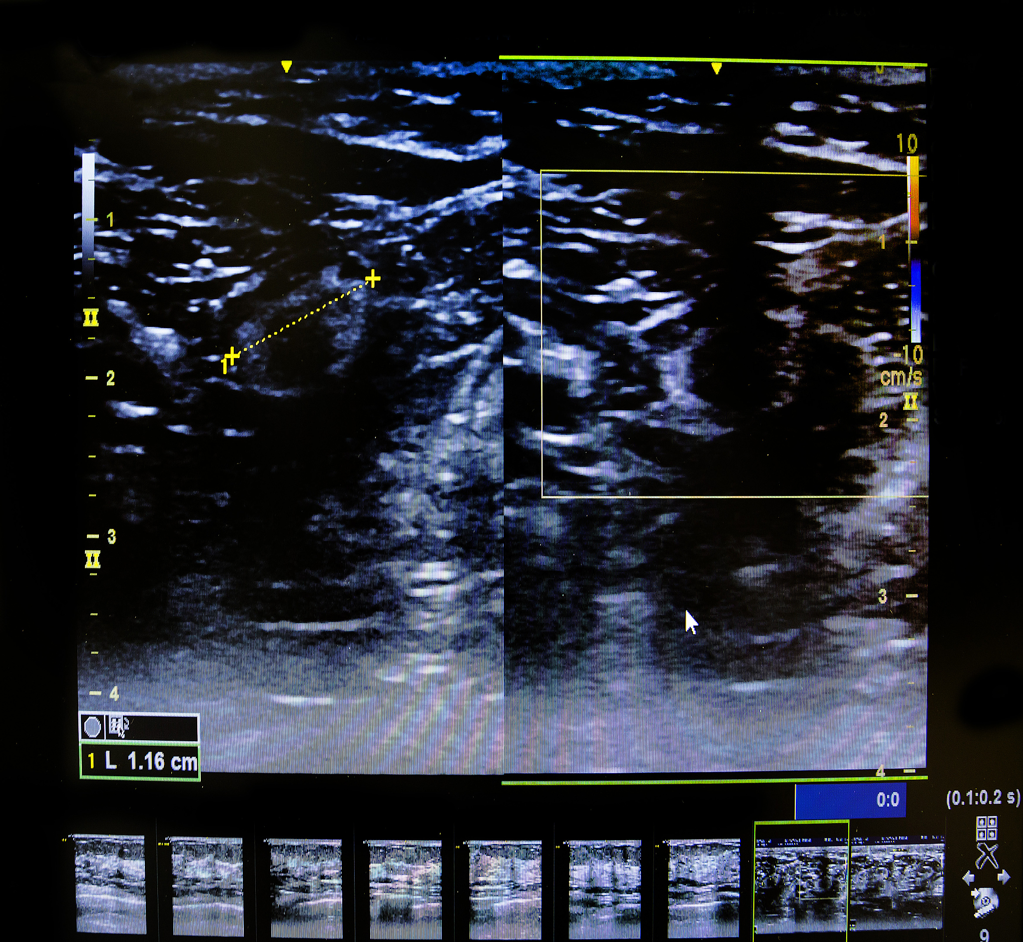 多普勒平滑伪距应该在误差改正前还是改正后多普勒平滑伪距应该在误差改正前进行因为平滑伪距是通过对多次测量得到的伪距进行平滑处理得到的因此应该在进行误差改正之前使用。如果先进行误差改正再进行平滑处理可能会使平滑效果不佳甚至可能导致更大的误差。因此正确的做法是先进行平滑处理再进行误差改正。多普勒平滑伪距只需要知道当前时刻和上一时刻的观测值吗不完全正确。虽然多普勒平滑伪距是通过对当前时刻和上一时刻的观测值