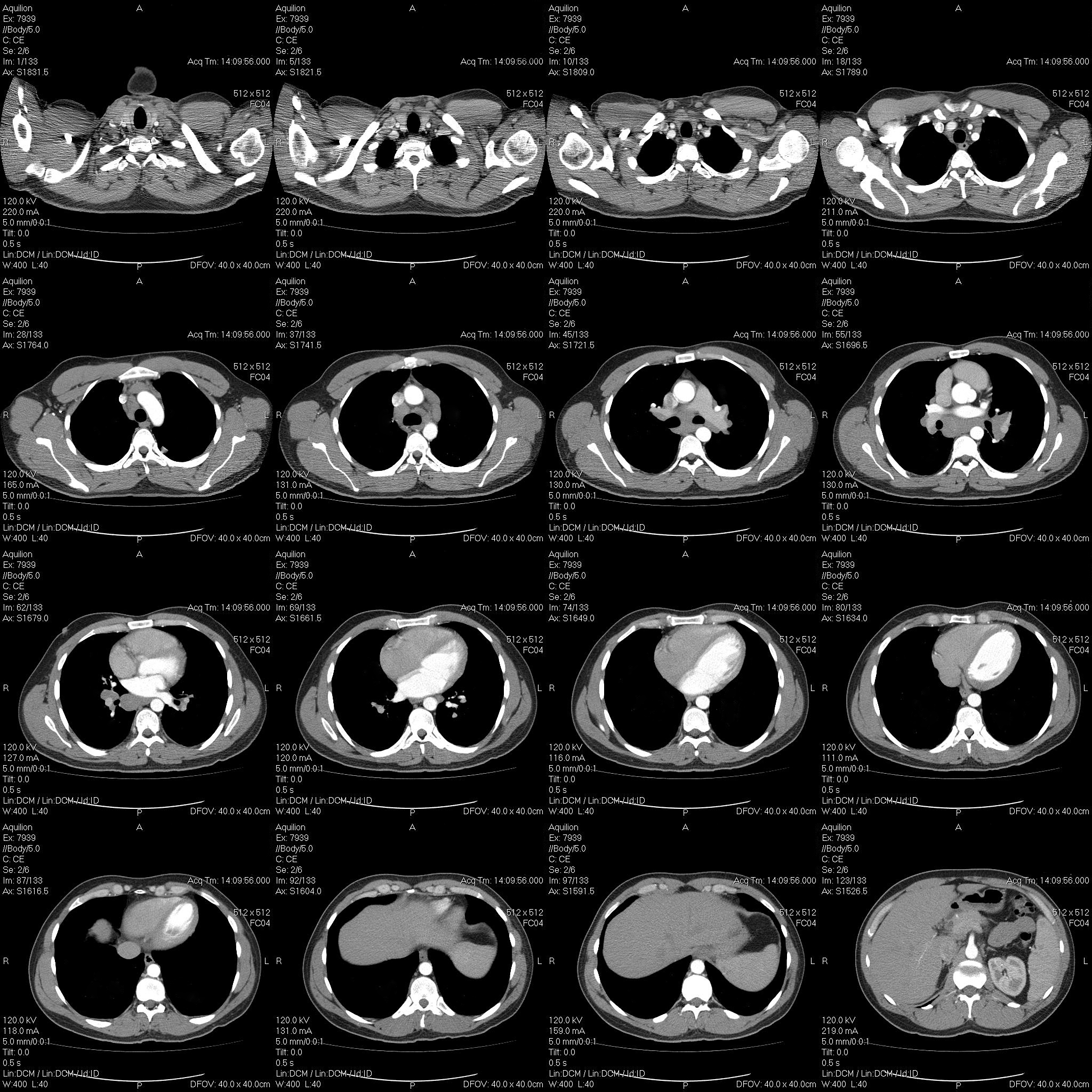 CT扫描在诊断和评估结节性甲状腺肿中的价值