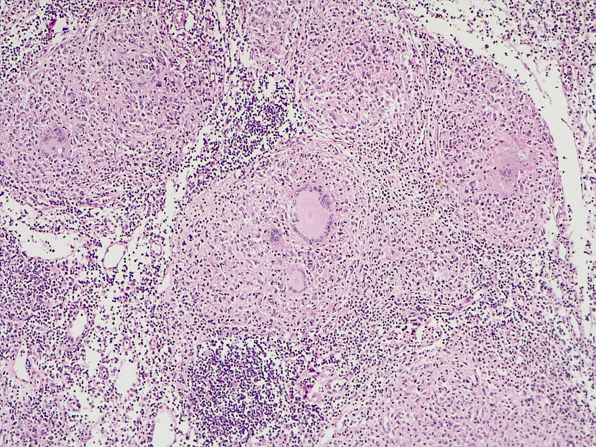 瘰疬分枝杆菌很容易检出吗