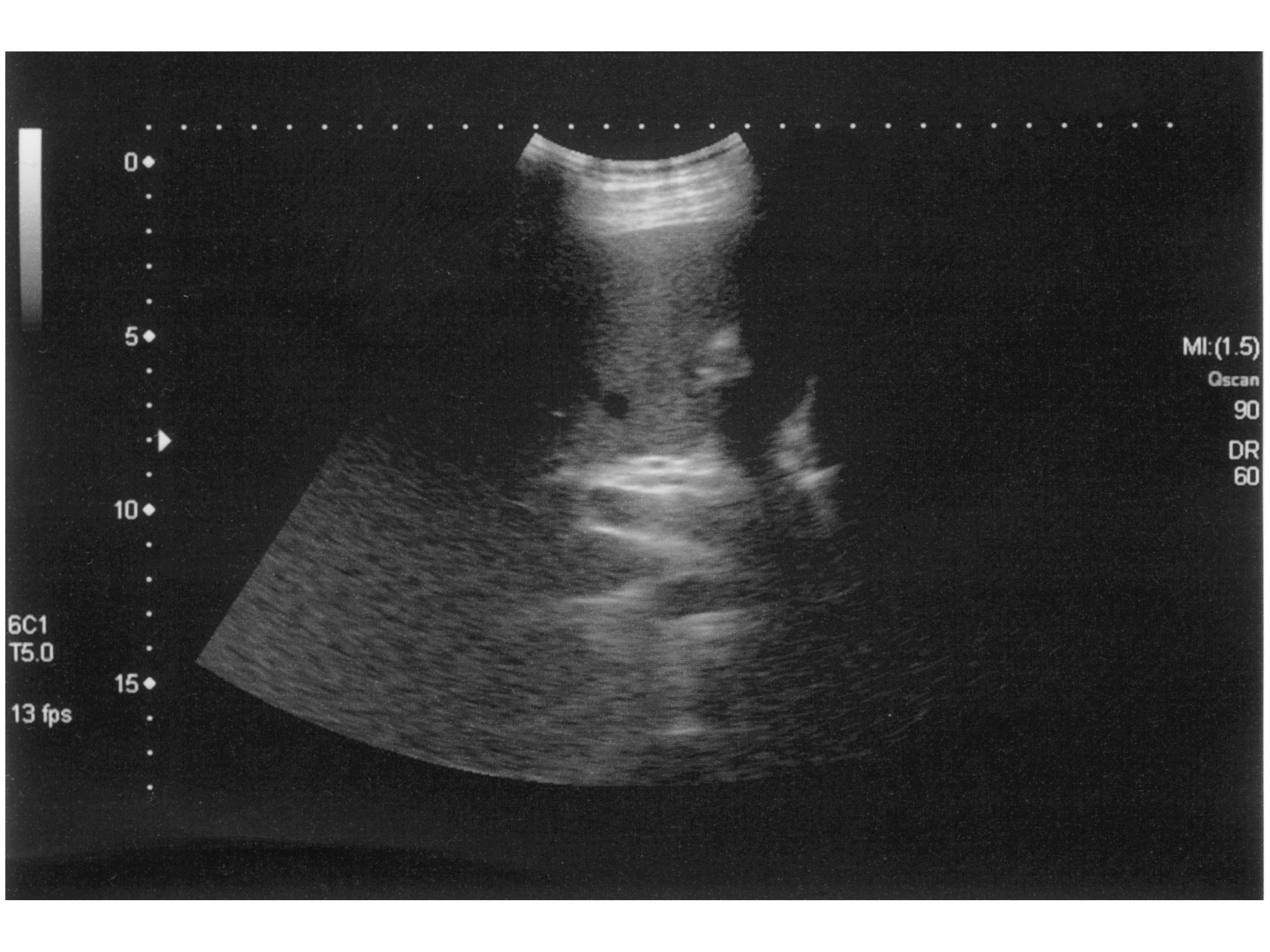 腔内超声造影在胆管疾病中的应用 - 提高诊断准确性的利器