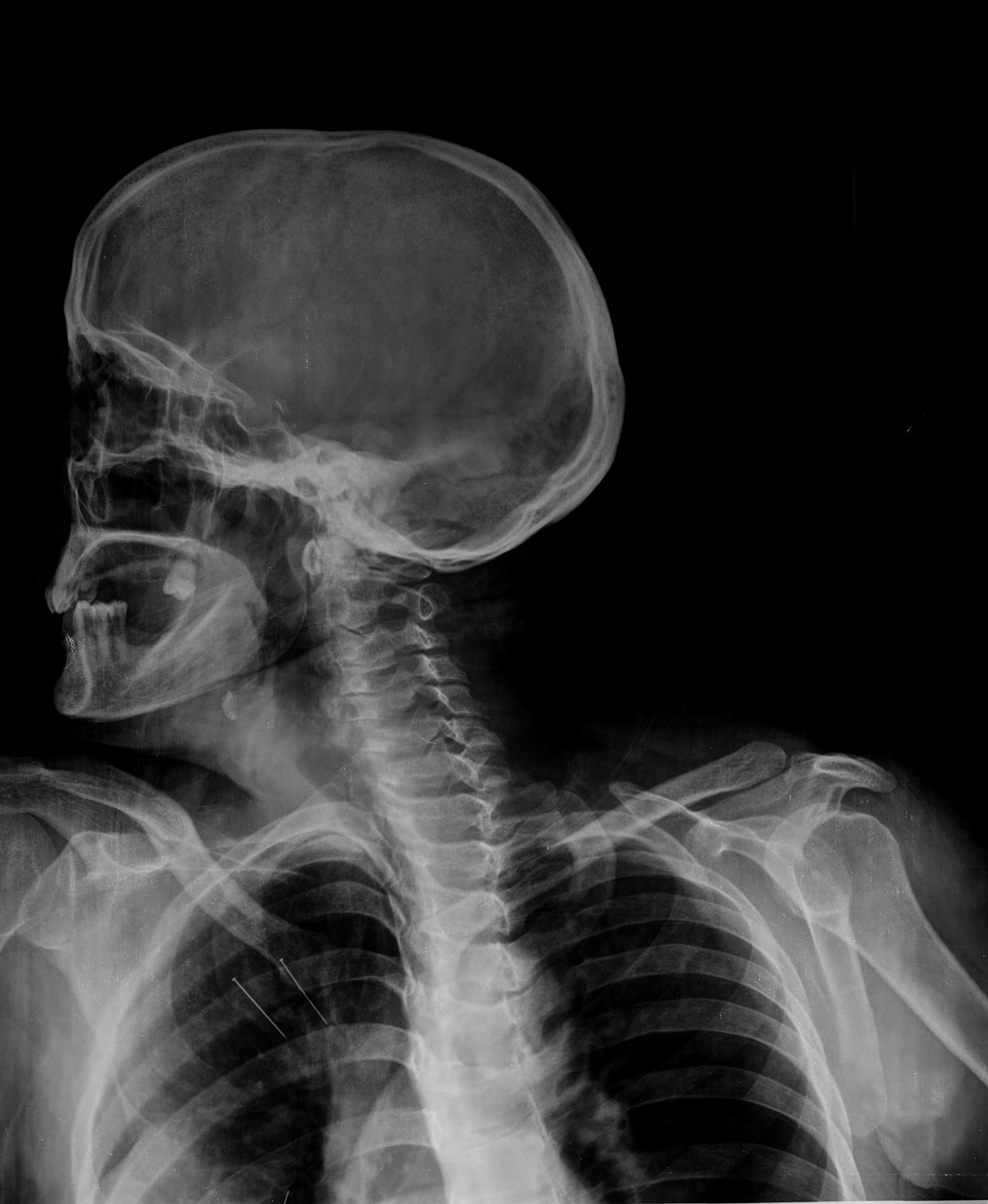 三凹征：误吸入物体后出现的三个部位凹陷