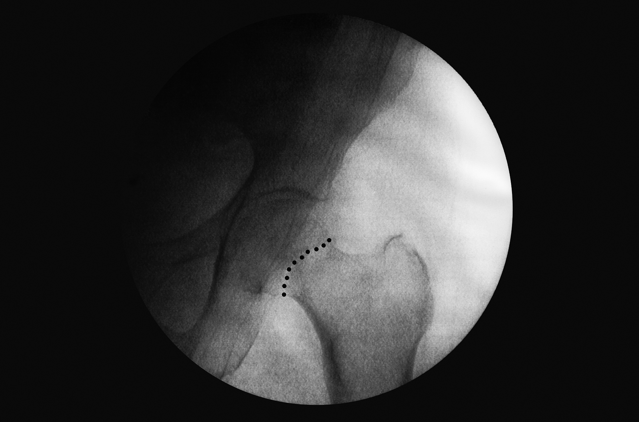 椎管内麻醉对高龄股骨粗隆间骨折手术效果的影响