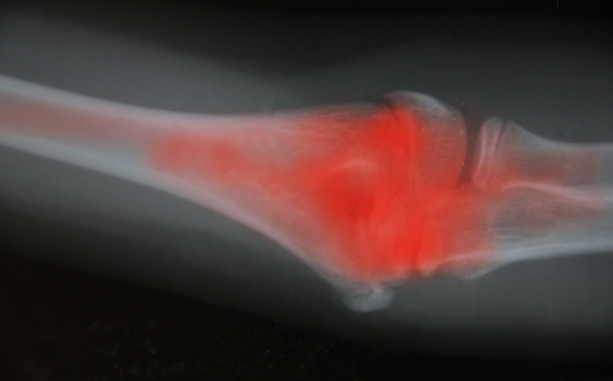 高龄股骨粗隆间骨折流行病学分析：高发人群、原因及后果