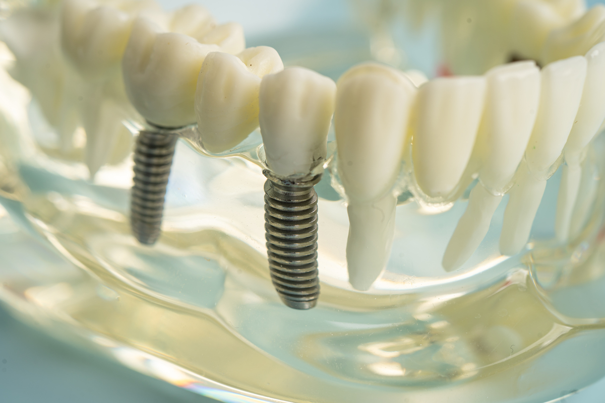 再生硅技术可以补牙么还有什么办法可以解决牙齿隐裂