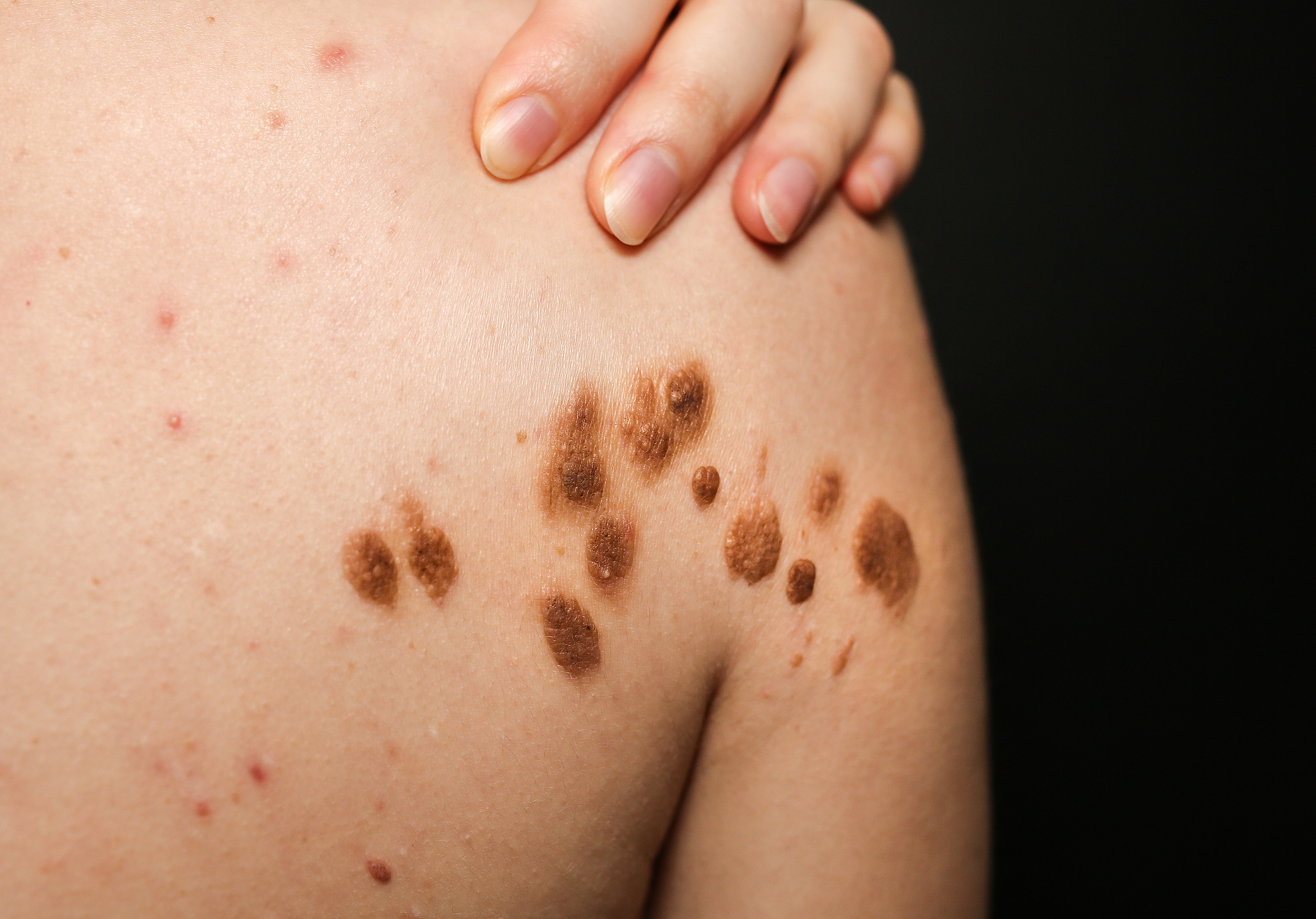 big birthmarks and freckles on the girl's skin. medical health p