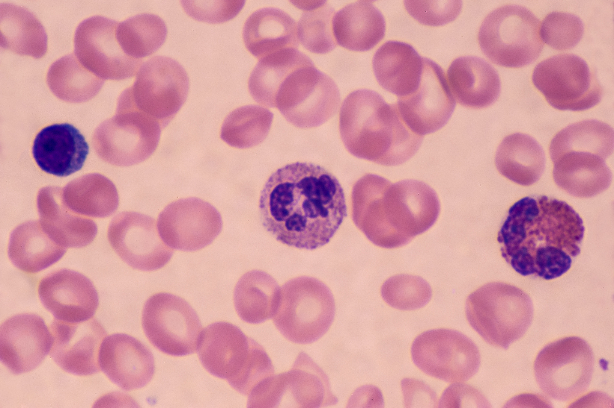 淋巴细胞百分比188中性粒细胞百分比761红细胞压积361分析一下