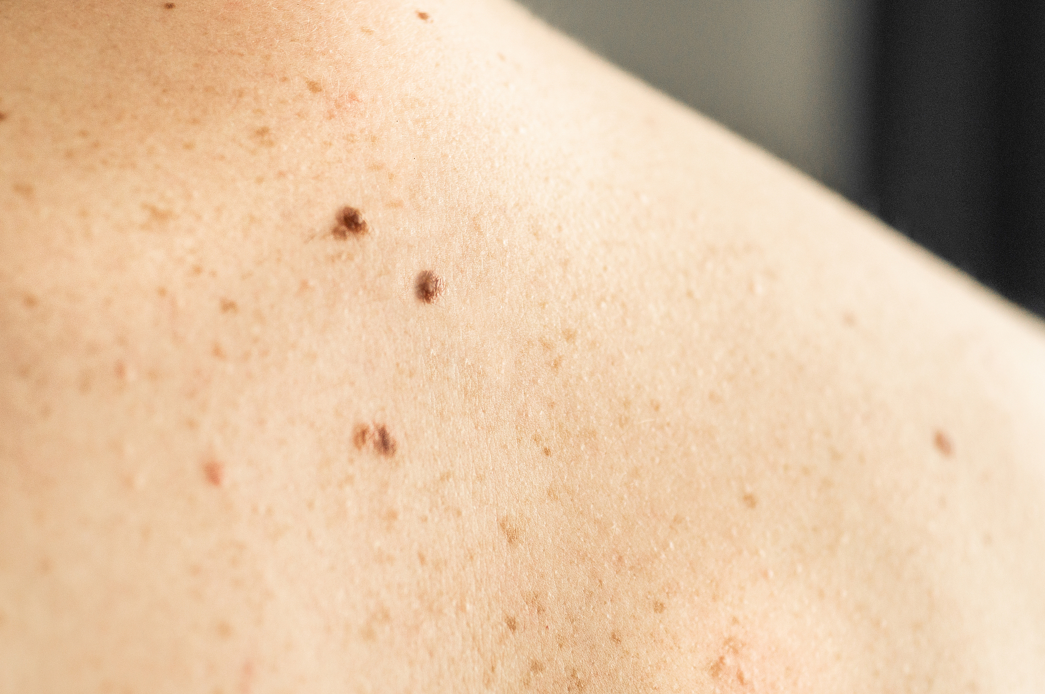close up detail of the bare skin on a man back with scattered mo
