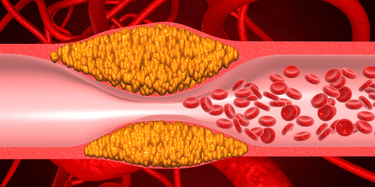 冠心病心绞痛和心梗的关系：简单易懂的解释