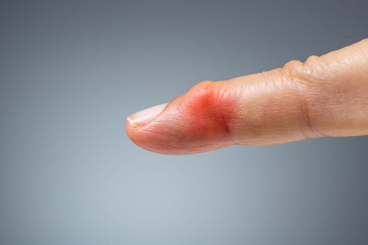 类风湿性关节炎 (RA) 简称及介绍 - 症状、治疗和生活方式