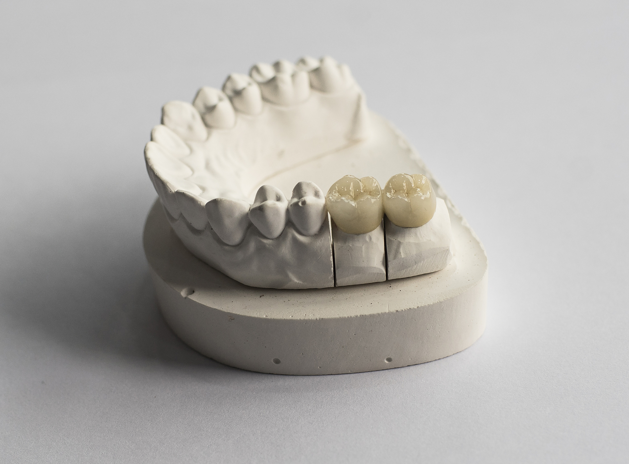写一下3D打印镂空结构的牙模的影响总结