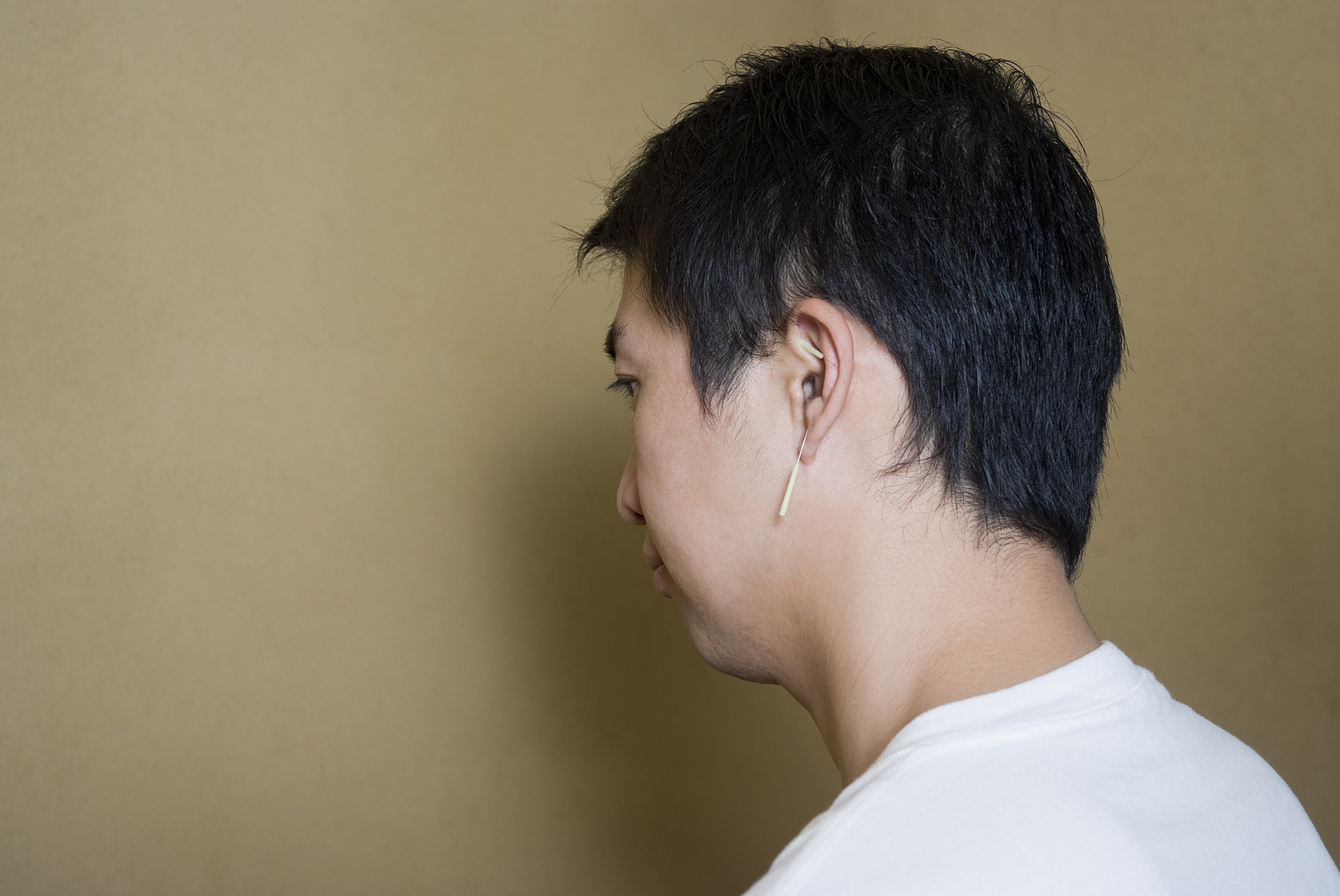 man receiving acupuncture treatment