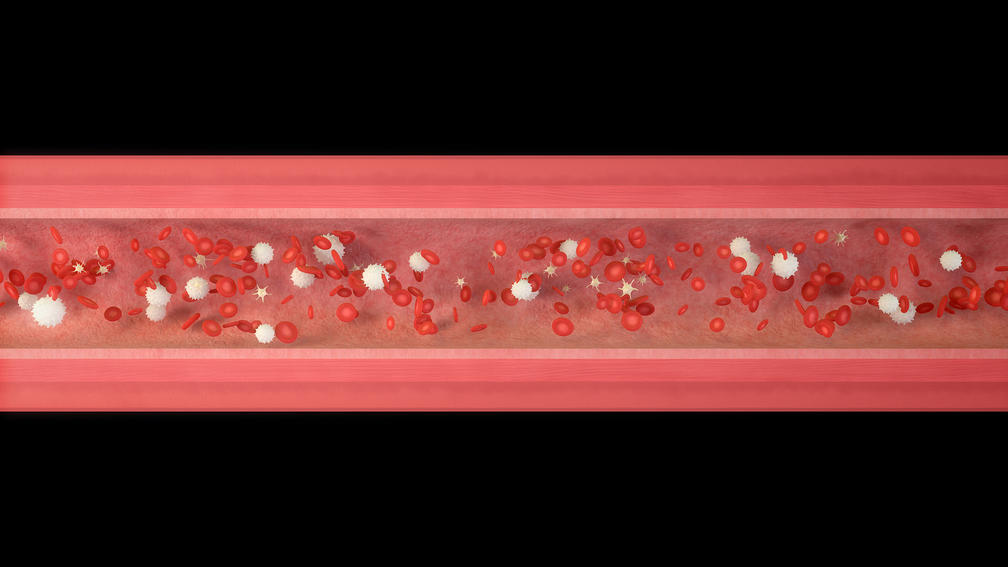 斑块内新生血管与炎症反应的相关性研究