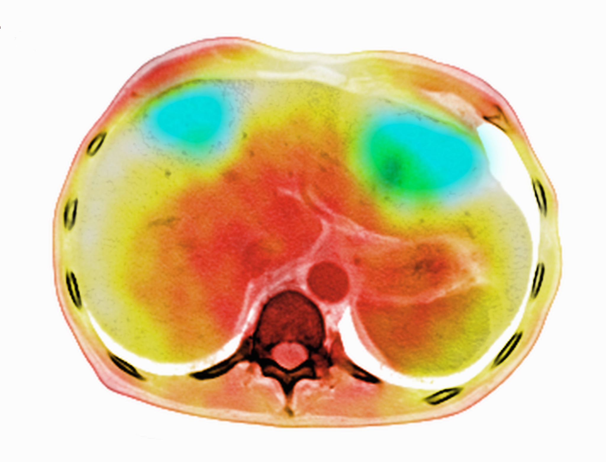 肺结节发现后，手术还是随访？如何选择？