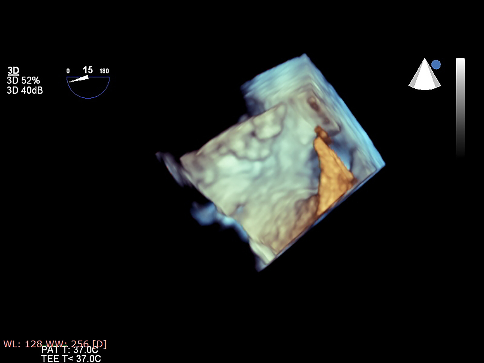 VTK 可视化 3D Unet 分割结果：CT 数据三维展示