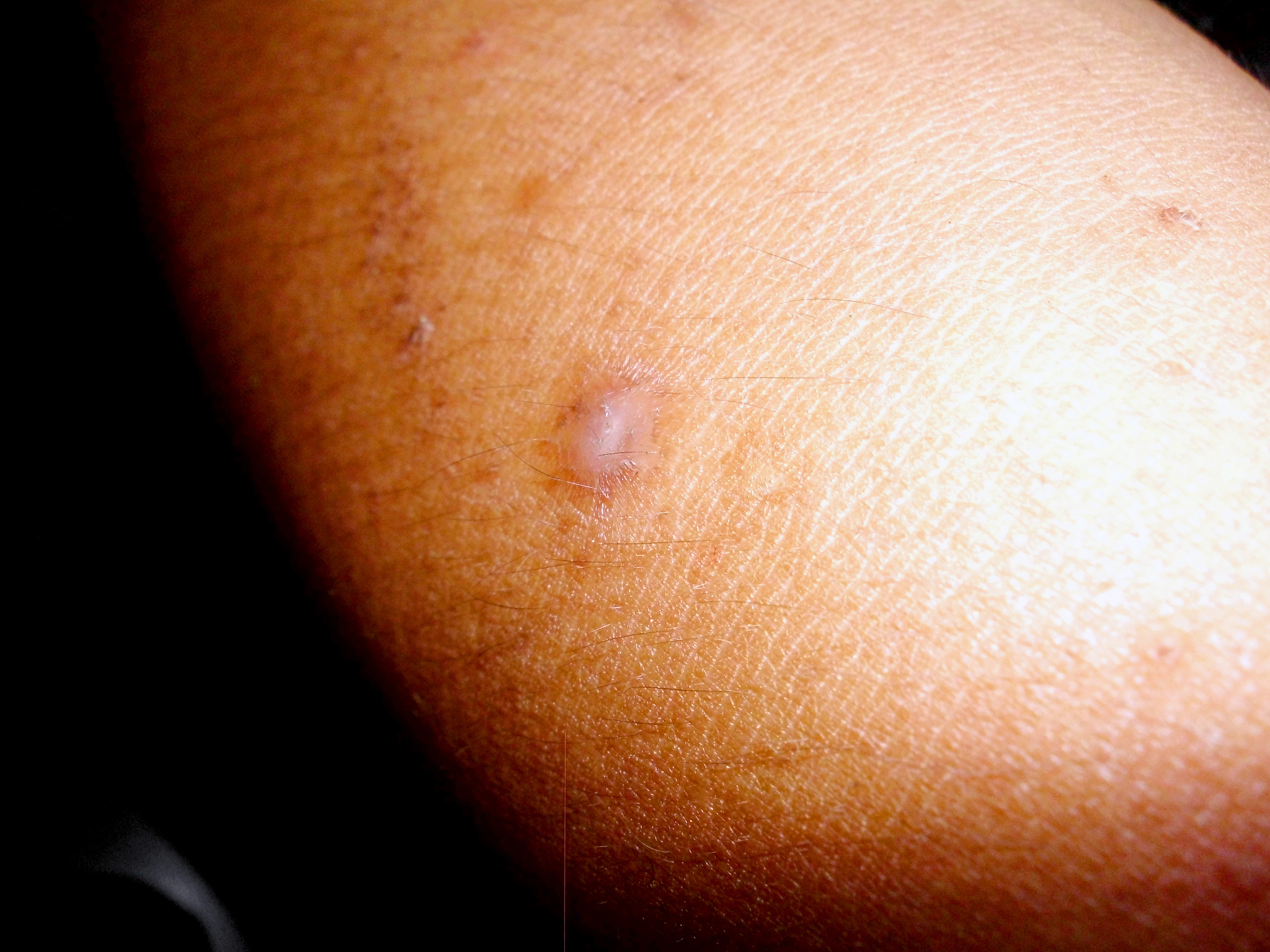scar on the skin. macro