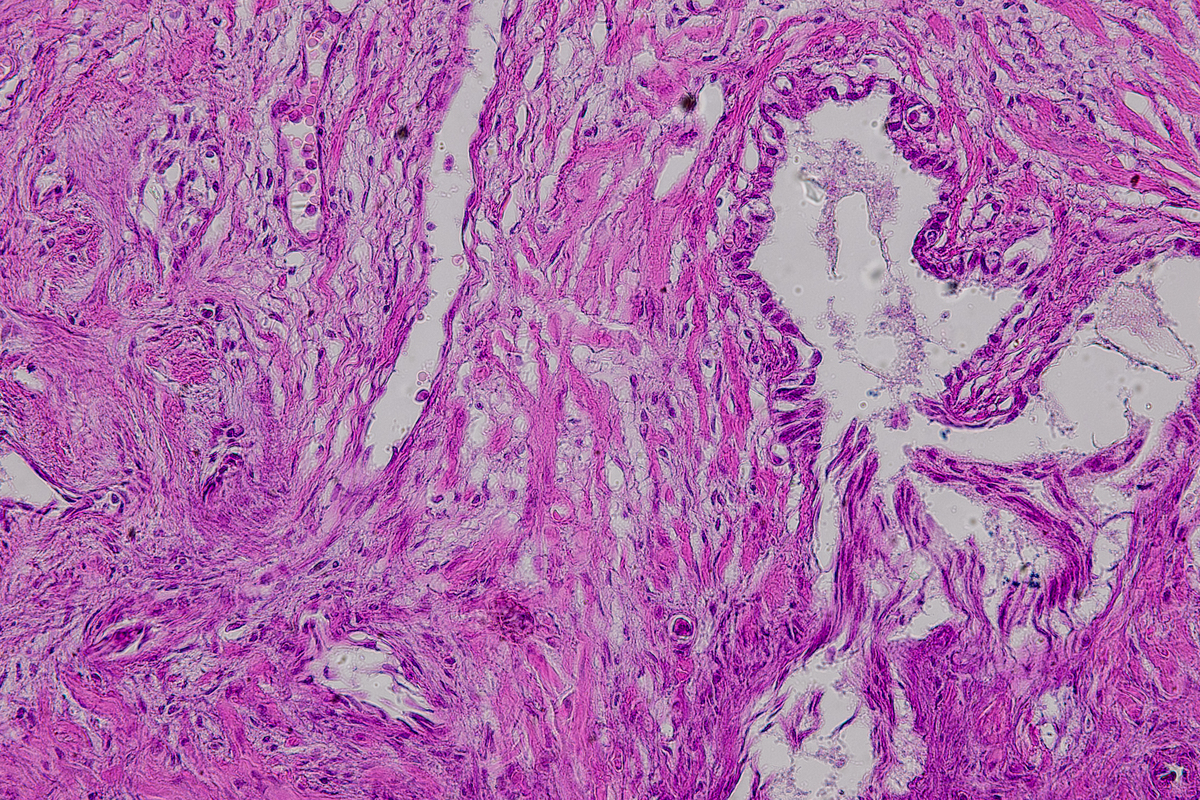 低级别肌成纤维母细胞肉瘤病例研究：诊断、治疗及预后