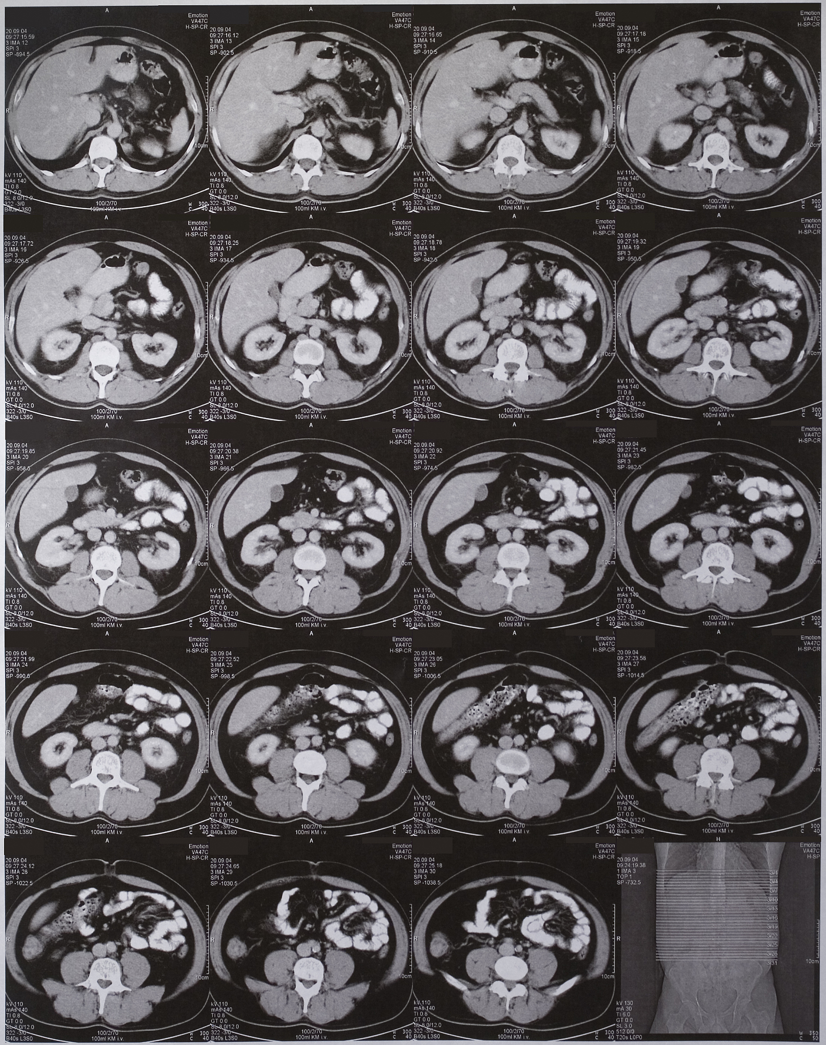 CT对右侧乳腺浸润性癌合并全身多发转移诊断的重要性及声像图特征