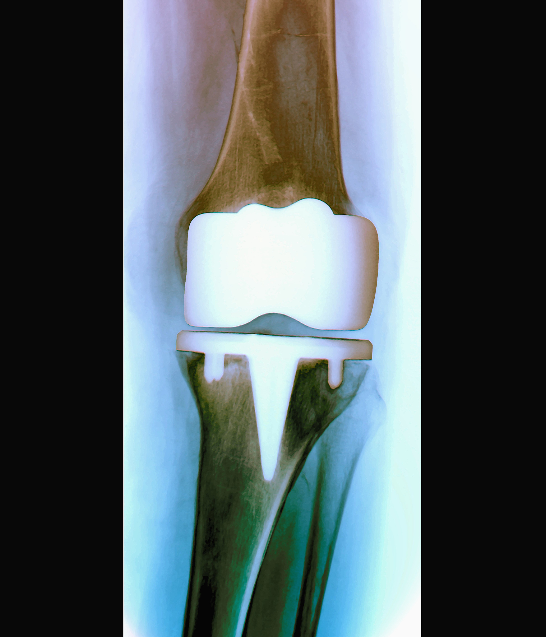 膝关节表面置换术治疗骨性关节炎：保留健康，重获生活质量