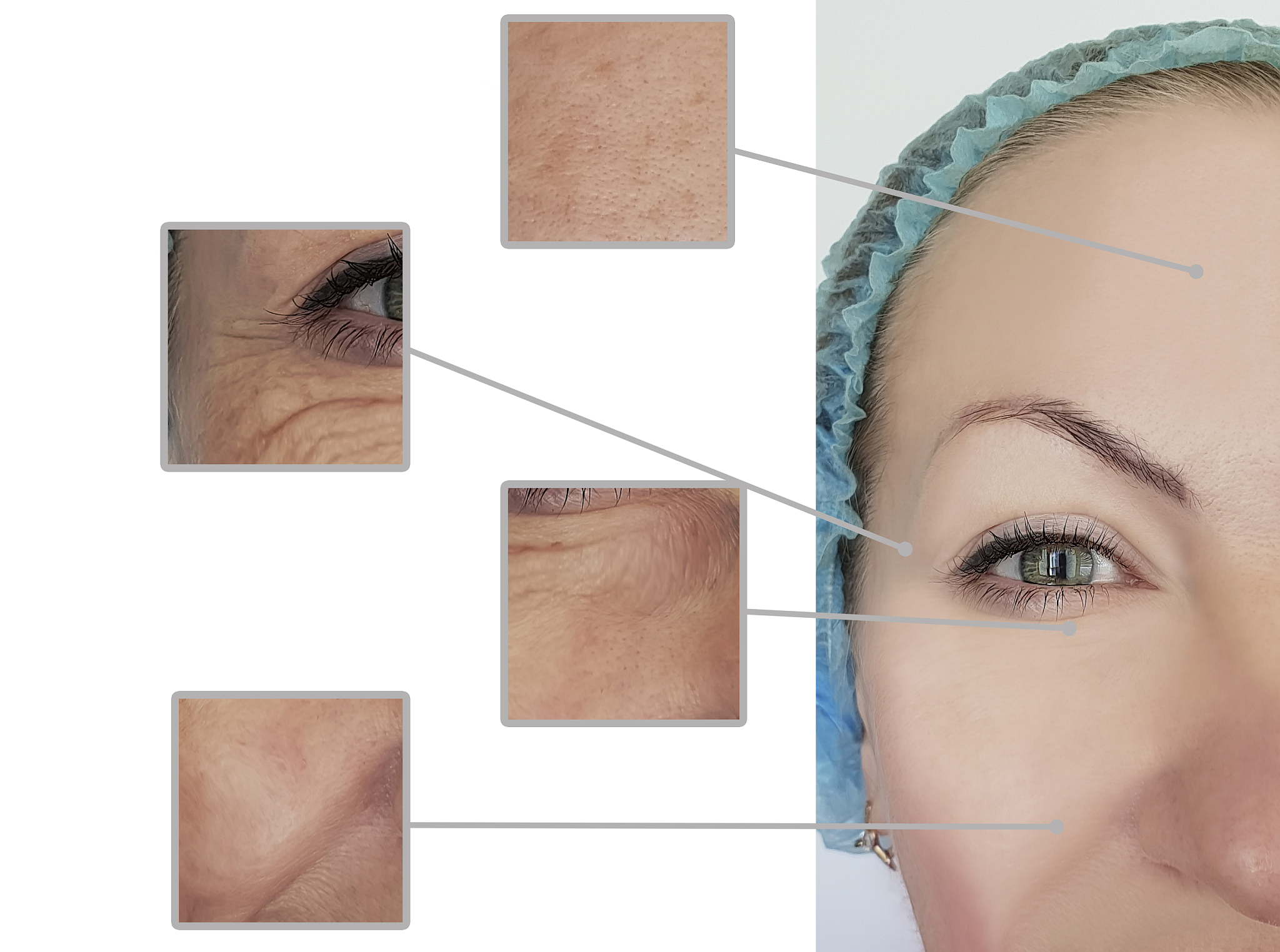 眼纹、法令纹、玻尿酸、眼袋科普：轻医美护肤指南