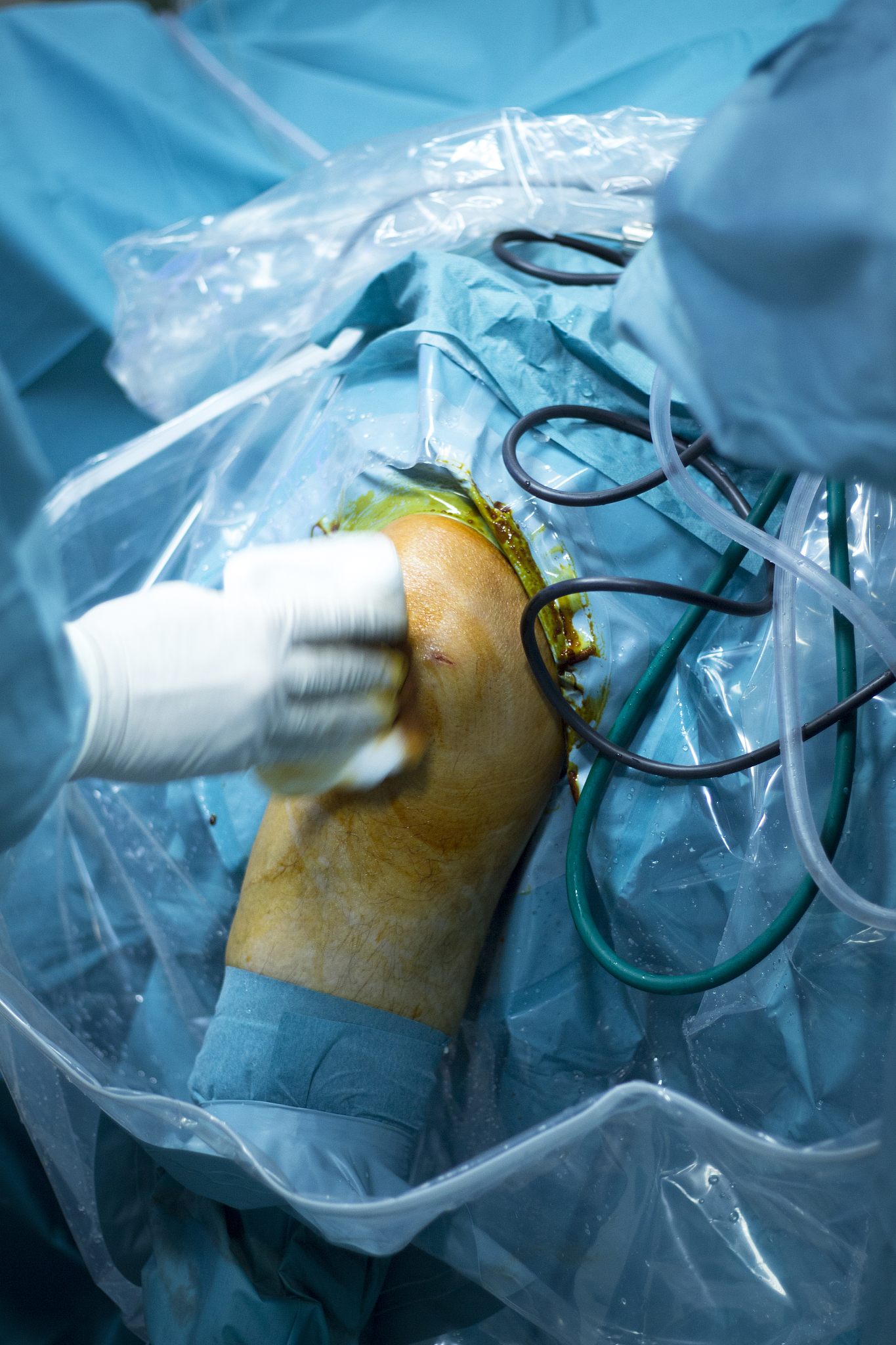 knee arthroscopy orthopedic surgery operation