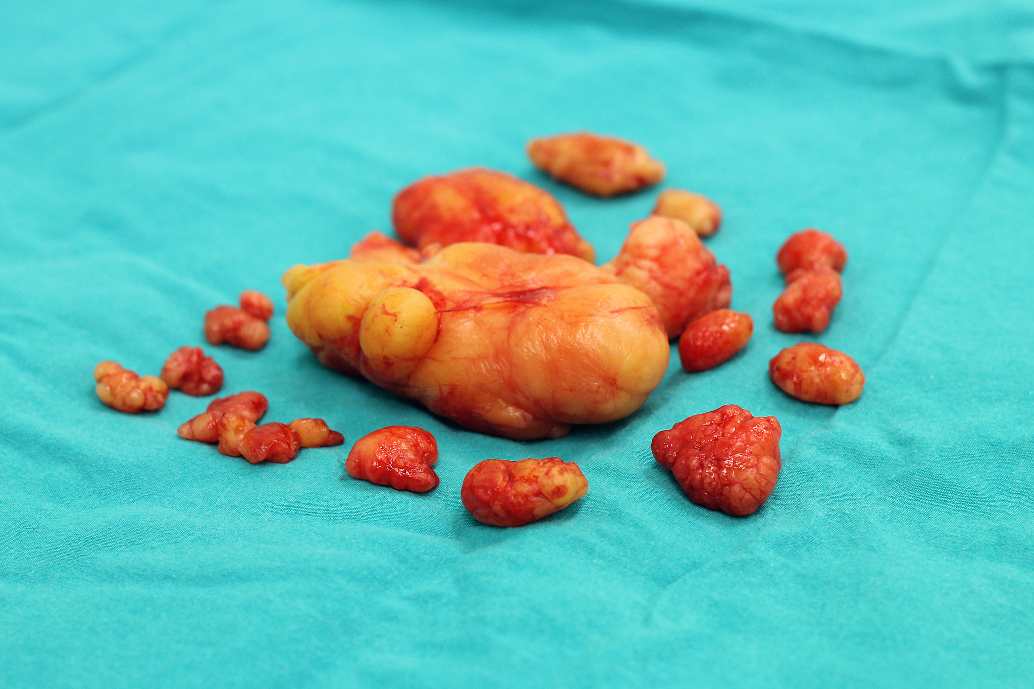 脂肪瘤 怎么办 脂肪瘤 怎么办