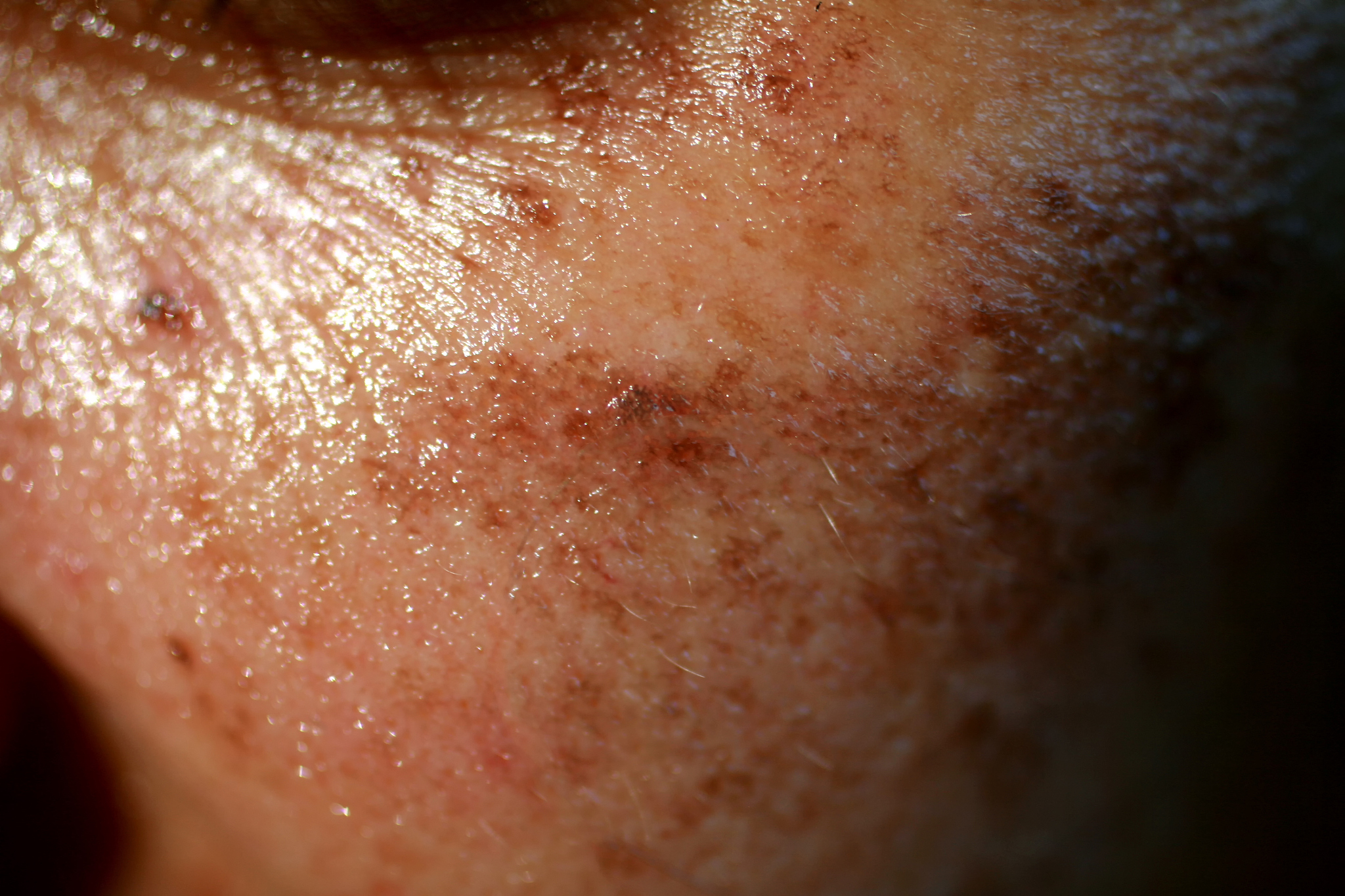 pigmented spots on the face. pigmentation on cheeks