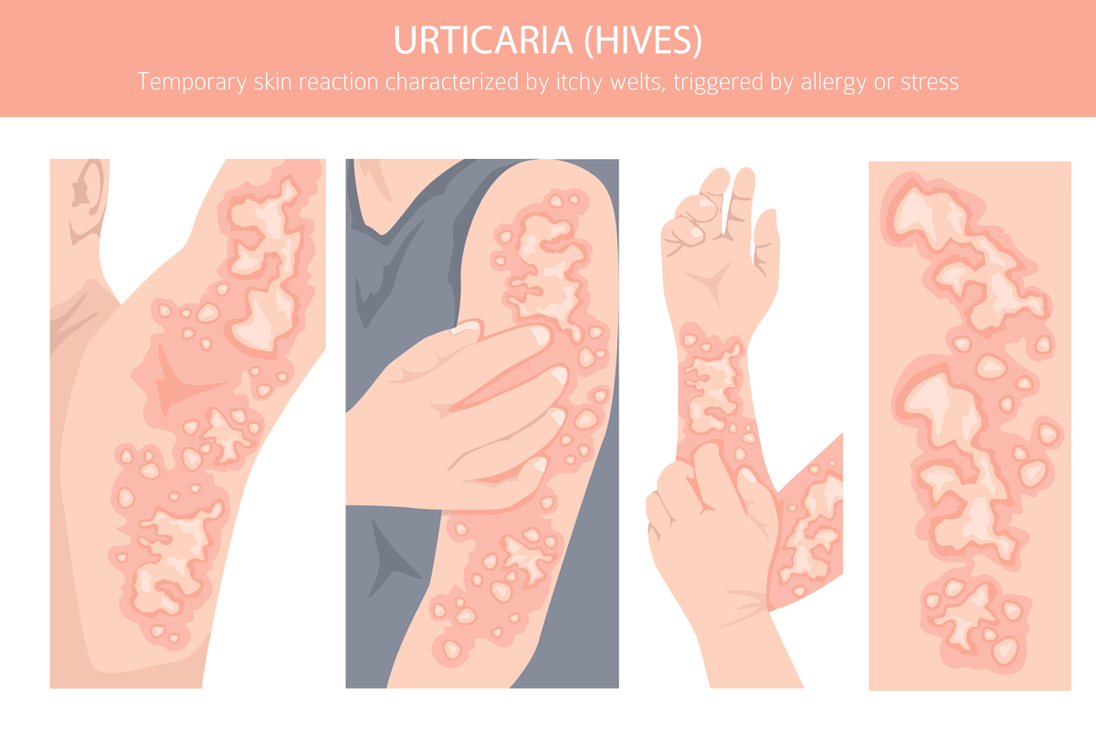 胆碱能性荨麻疹如何影响生活