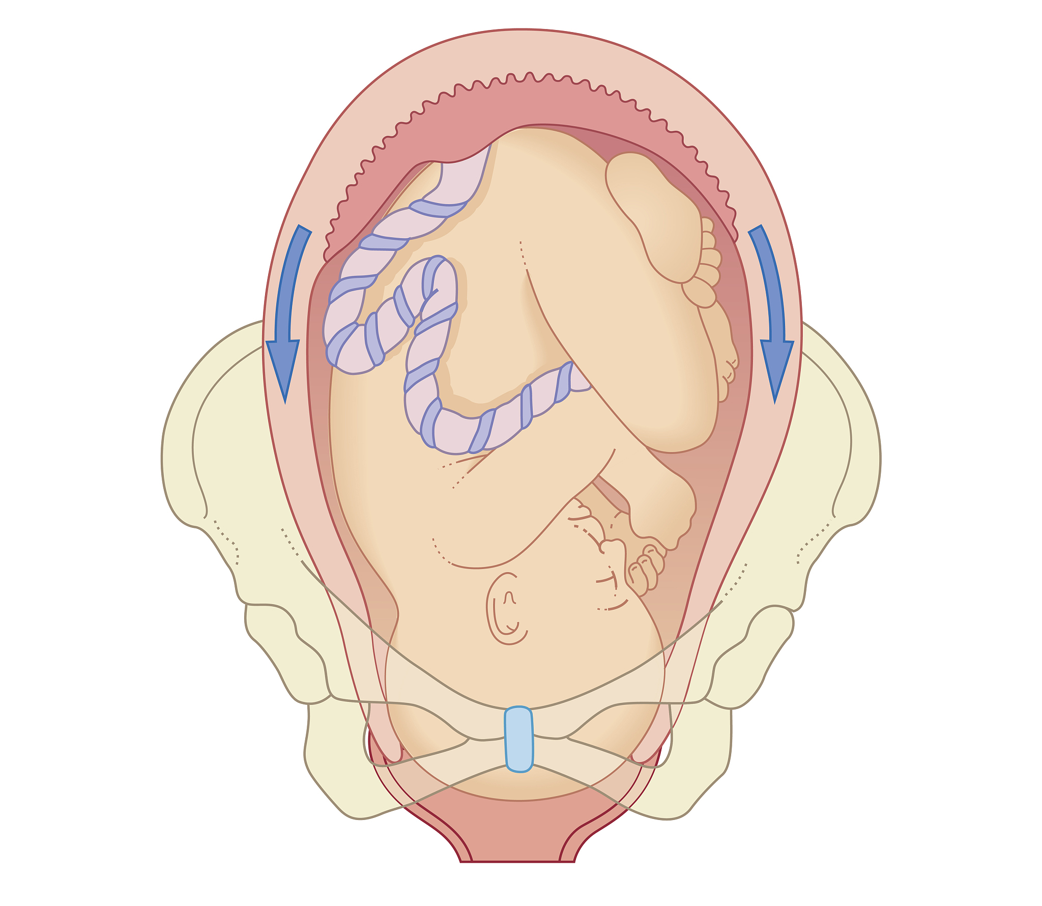 坐骨包容接受腔