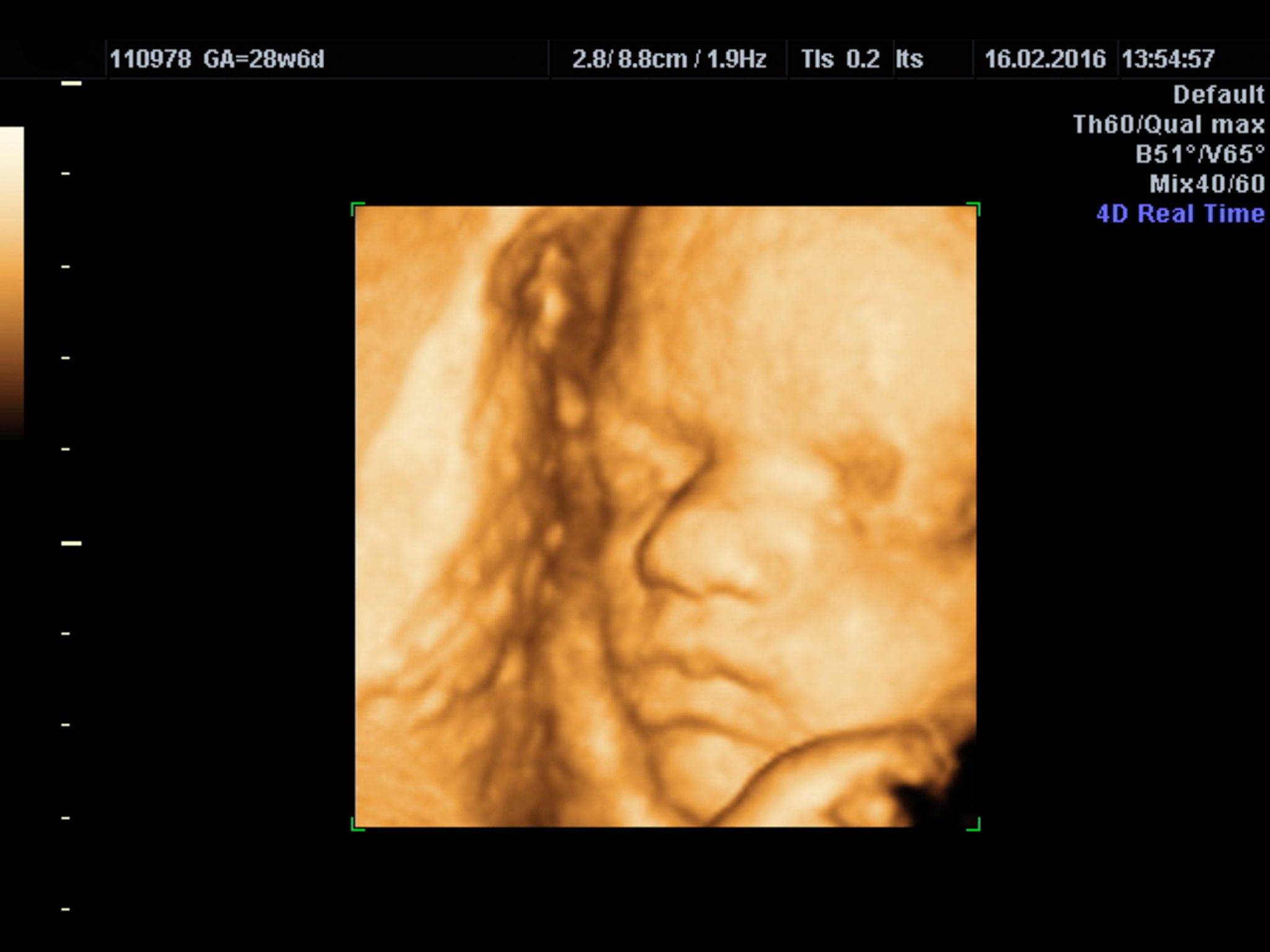 四维羊水最大深度80.7mm：正常范围，胎儿发育良好