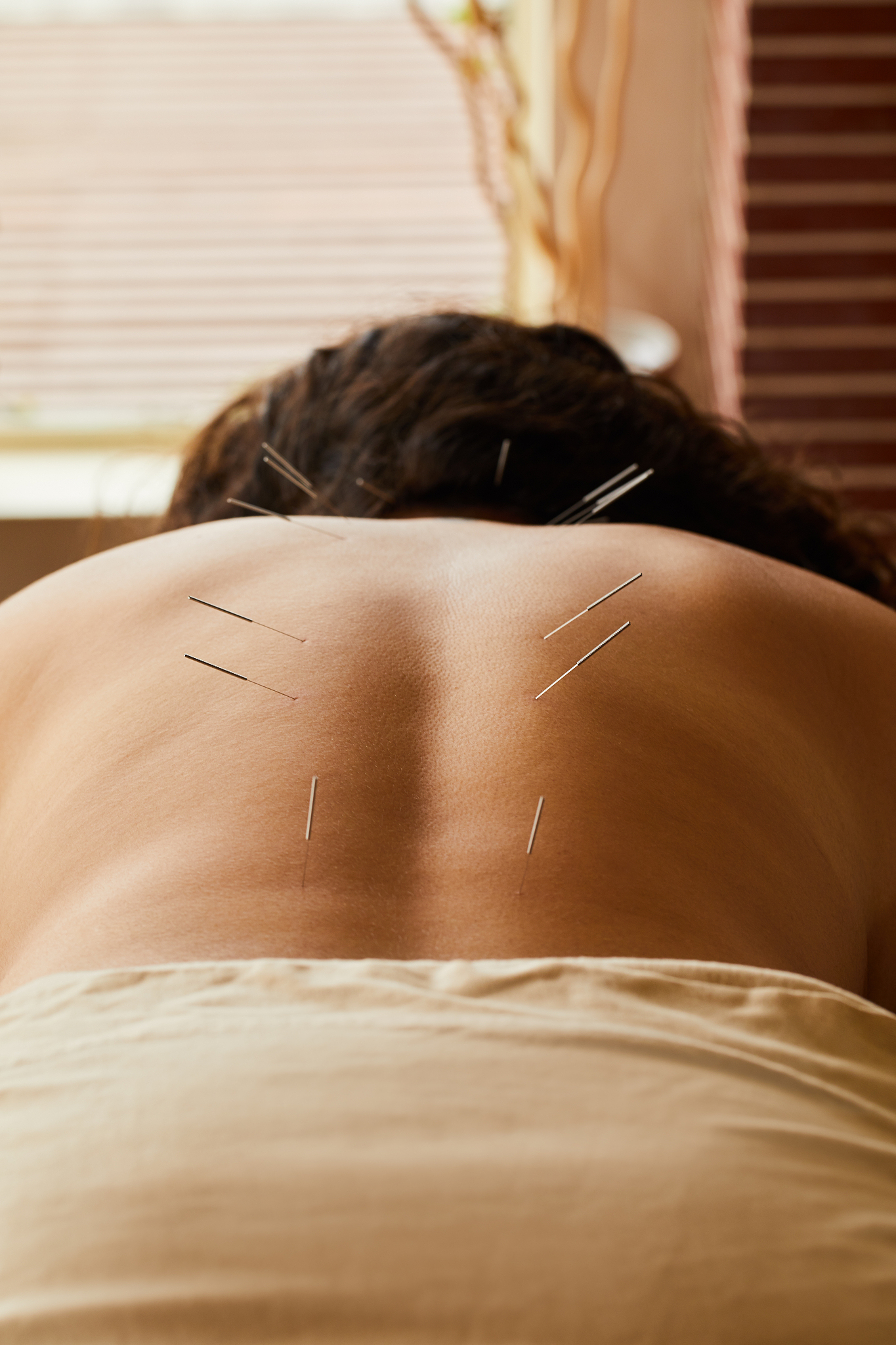 woman having an acupuncture treatment on her back