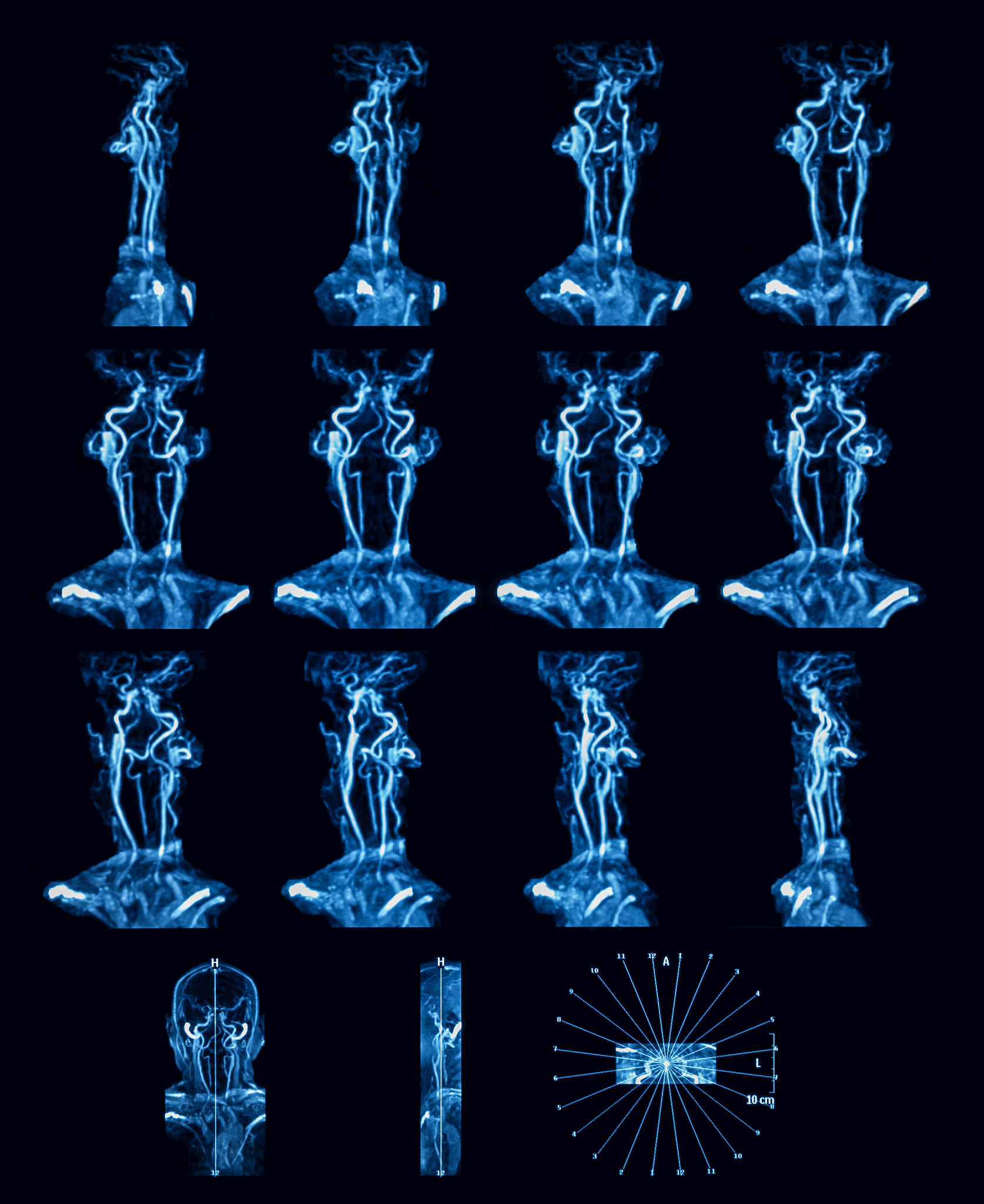 颈动脉斑块破裂漂浮血栓超声造影罕见病例报道